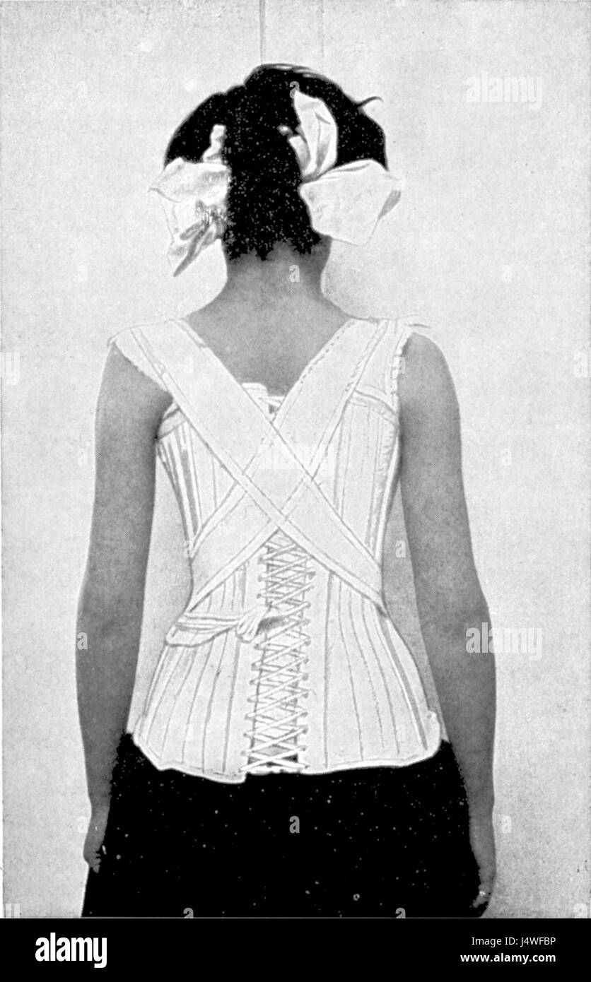 Una descrizione dettagliata di un corsetto VanWinkle, specificamente progettato e regolato per trattare la scoliosi con una marcata curvatura dalla dorsale alla lombare destra alla Taylor sinistra. Foto Stock