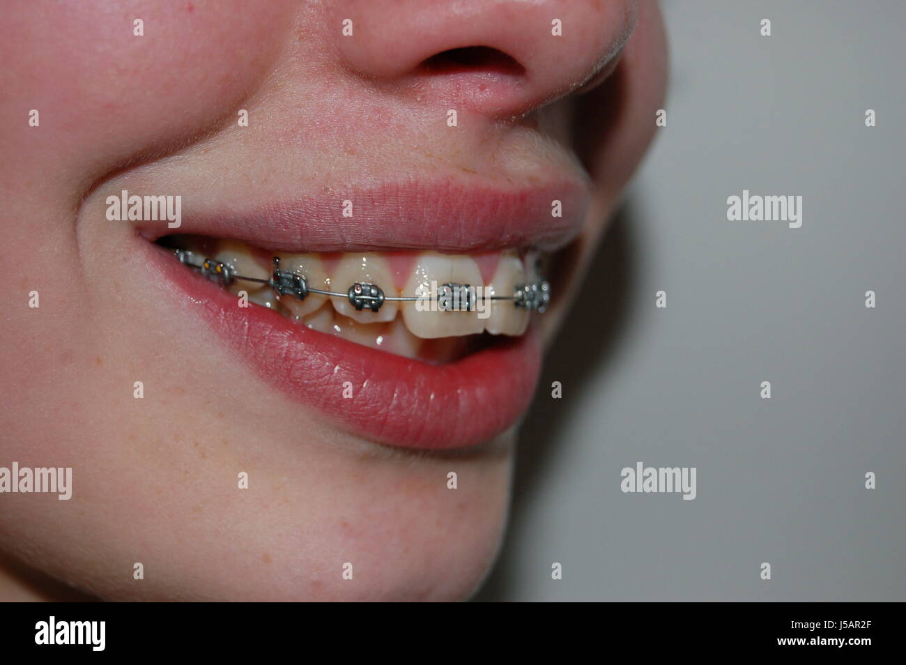 Bocca,denti,bretella,chiusura,rosso,labbro,zahnkorrektur,zahnstellung Foto Stock