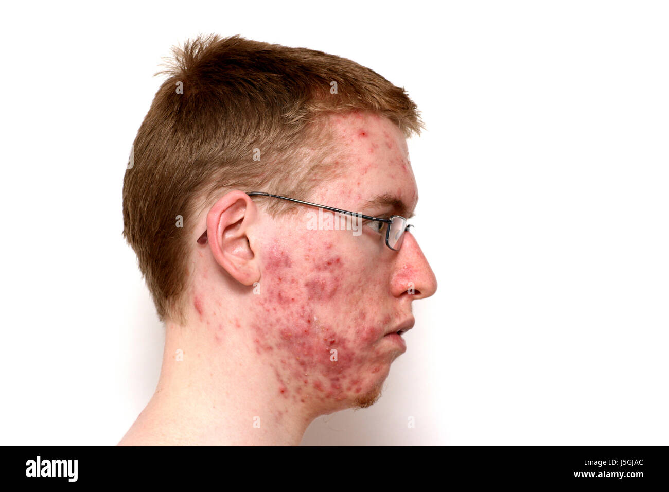 Inizio del trattamento con isotretinoina acne Foto Stock