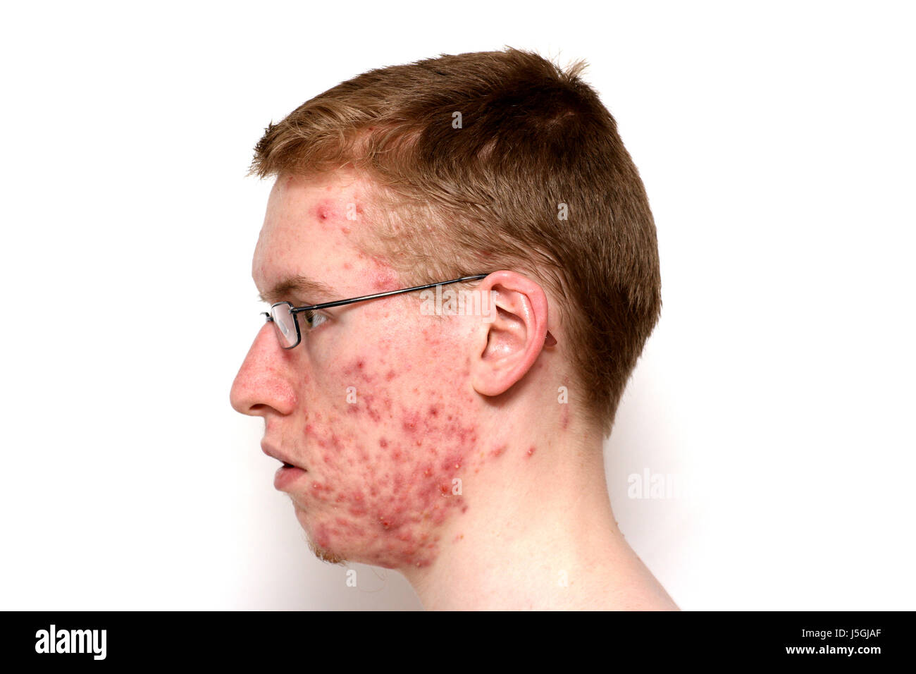 Problema di profilo prurito brufolo acne malattia della pelle dermatologo stelo teens Foto Stock