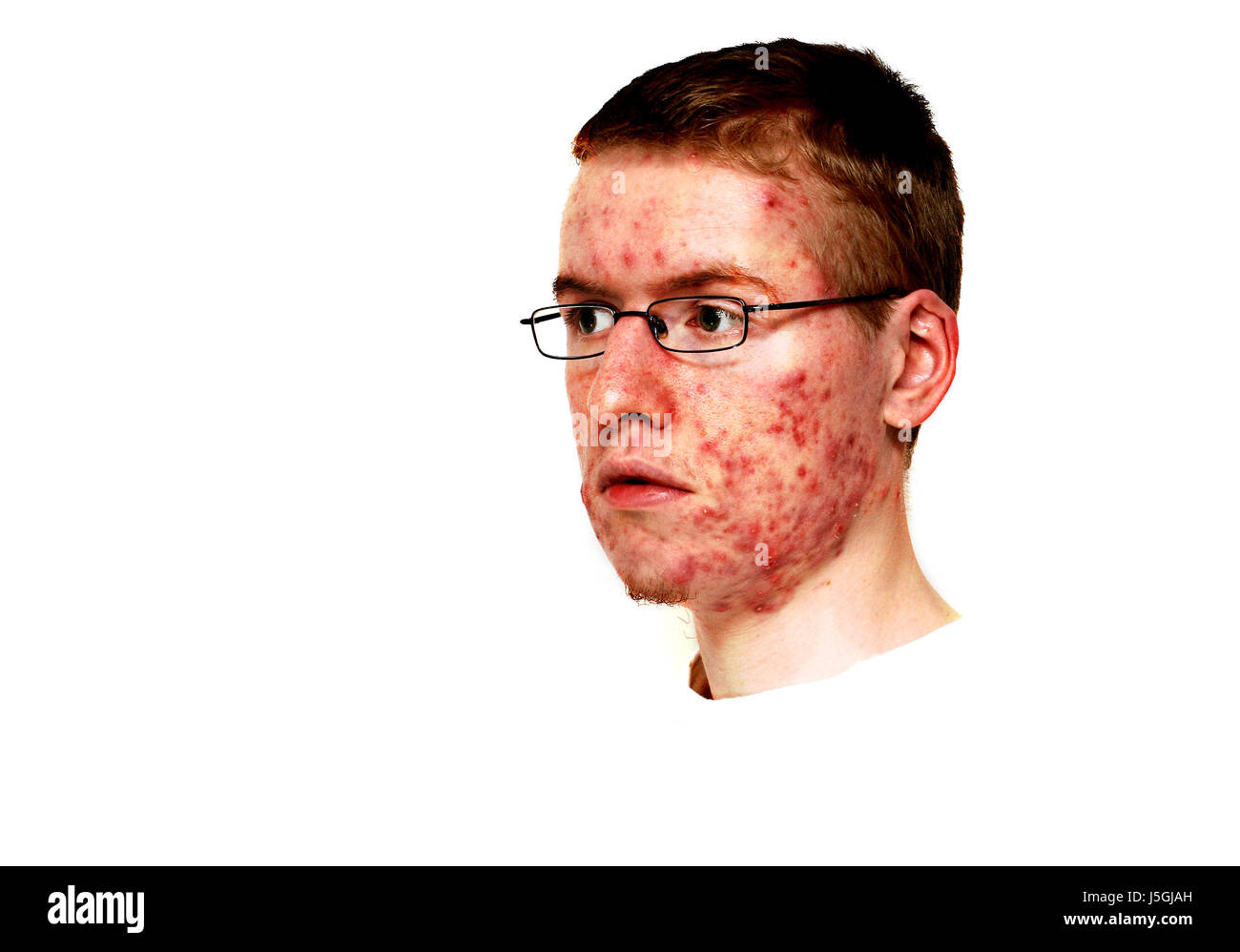 Problema di prurito brufolo acne malattia della pelle dermatologo stelo psicologici teens Foto Stock