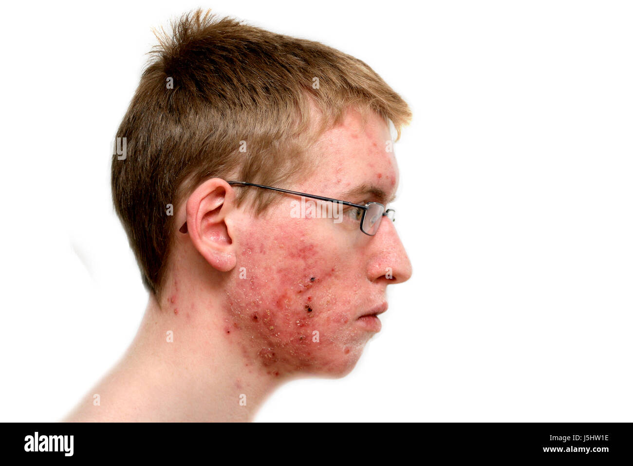 Problema di prurito brufolo acne malattia della pelle dermatologo stelo ragazzi adolescenti la gioventù Foto Stock