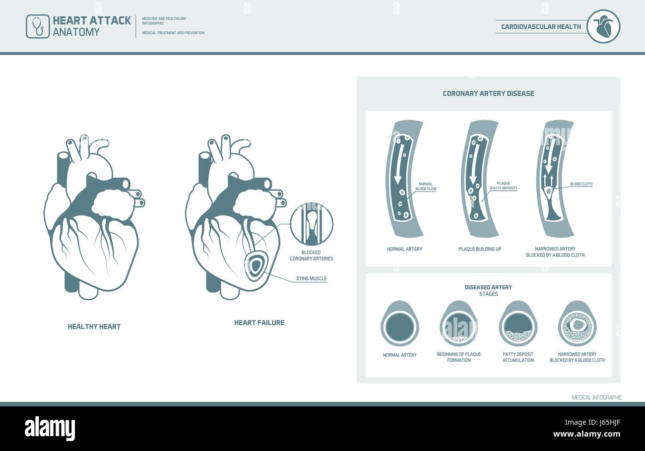 Un attacco di cuore e aterosclerosi Illustrazione medica: sano e cuore danneggiato, vaso sanguigno sezione con deposito di grasso accumulo Illustrazione Vettoriale
