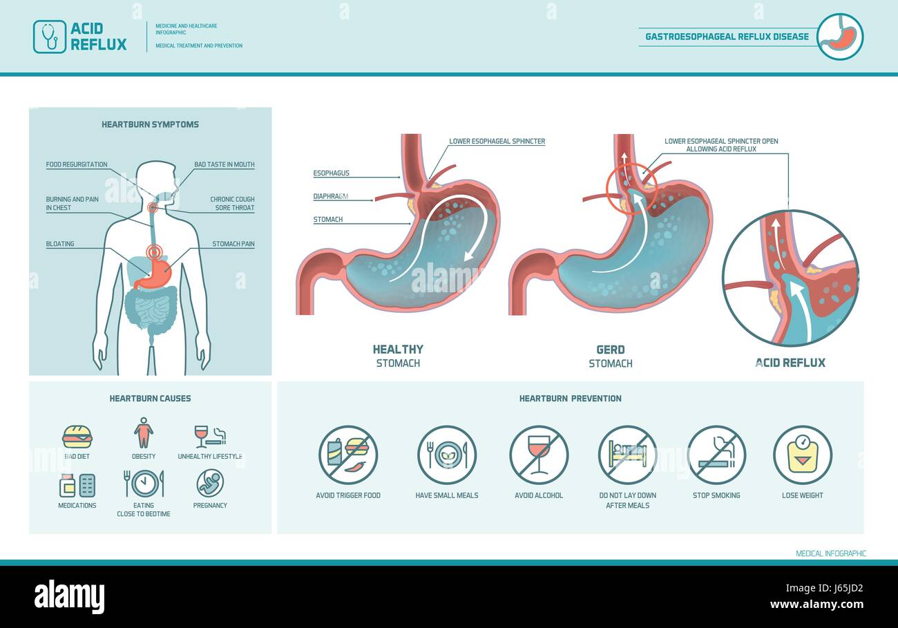 Reflusso acido, bruciori di stomaco e Gerd Una infografica con stomaco Illustrazione medica, sintomi, cause e prevenzione Illustrazione Vettoriale