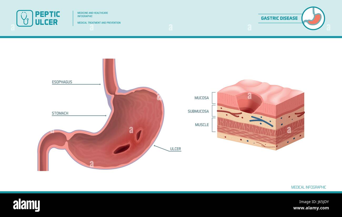 Stomaco e ulcera peptica: infiammate piaga sulla mucosa dello stomaco, rivestimento dello stomaco diagramma della sezione trasversale, Illustrazione medica Illustrazione Vettoriale