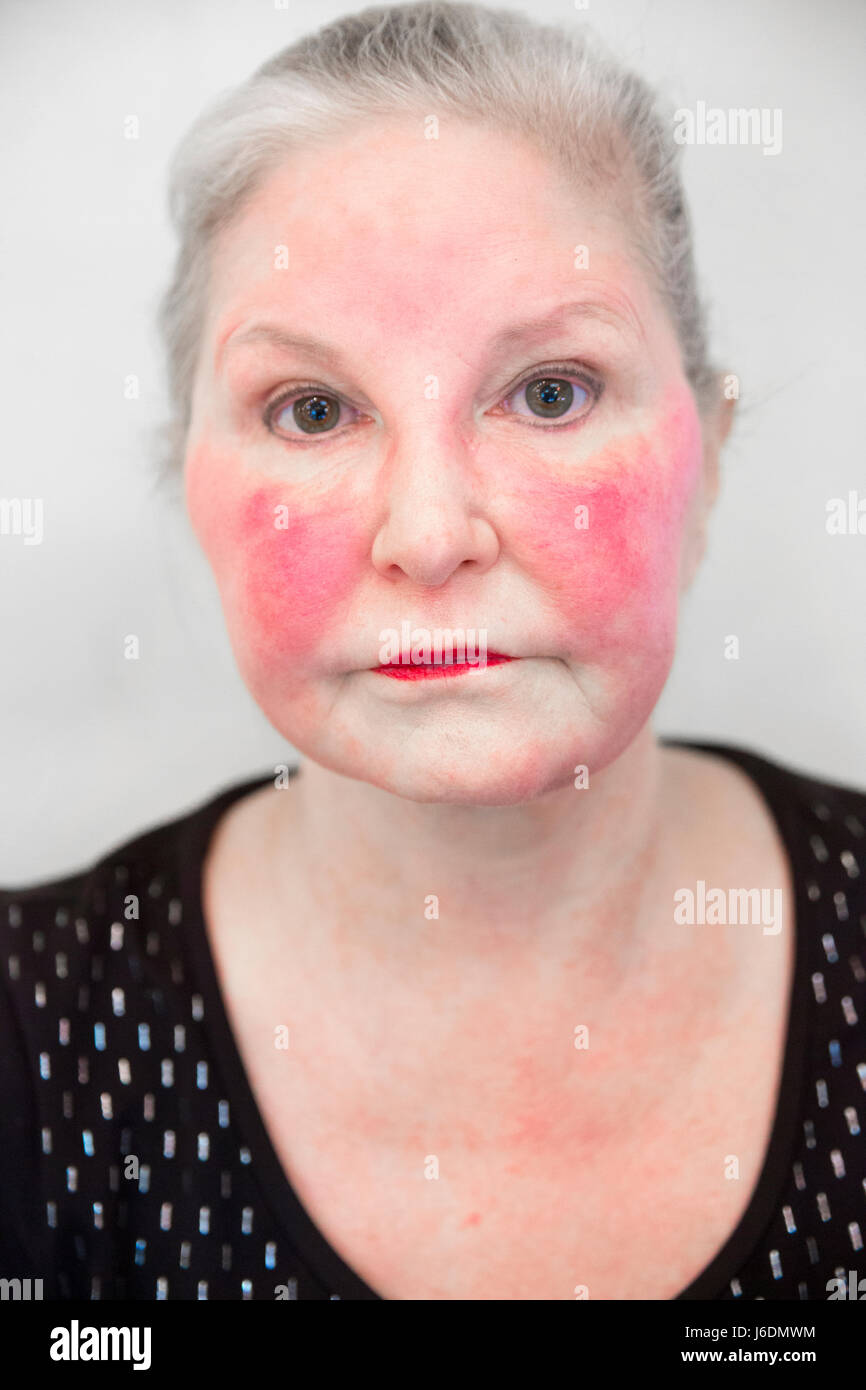 Vista laterale di una donna caucasica nel suo fine degli anni cinquanta è una malattia autoimmune o rosacea che ha provocato una grave red flush sul suo viso. 5D3 Foto Stock