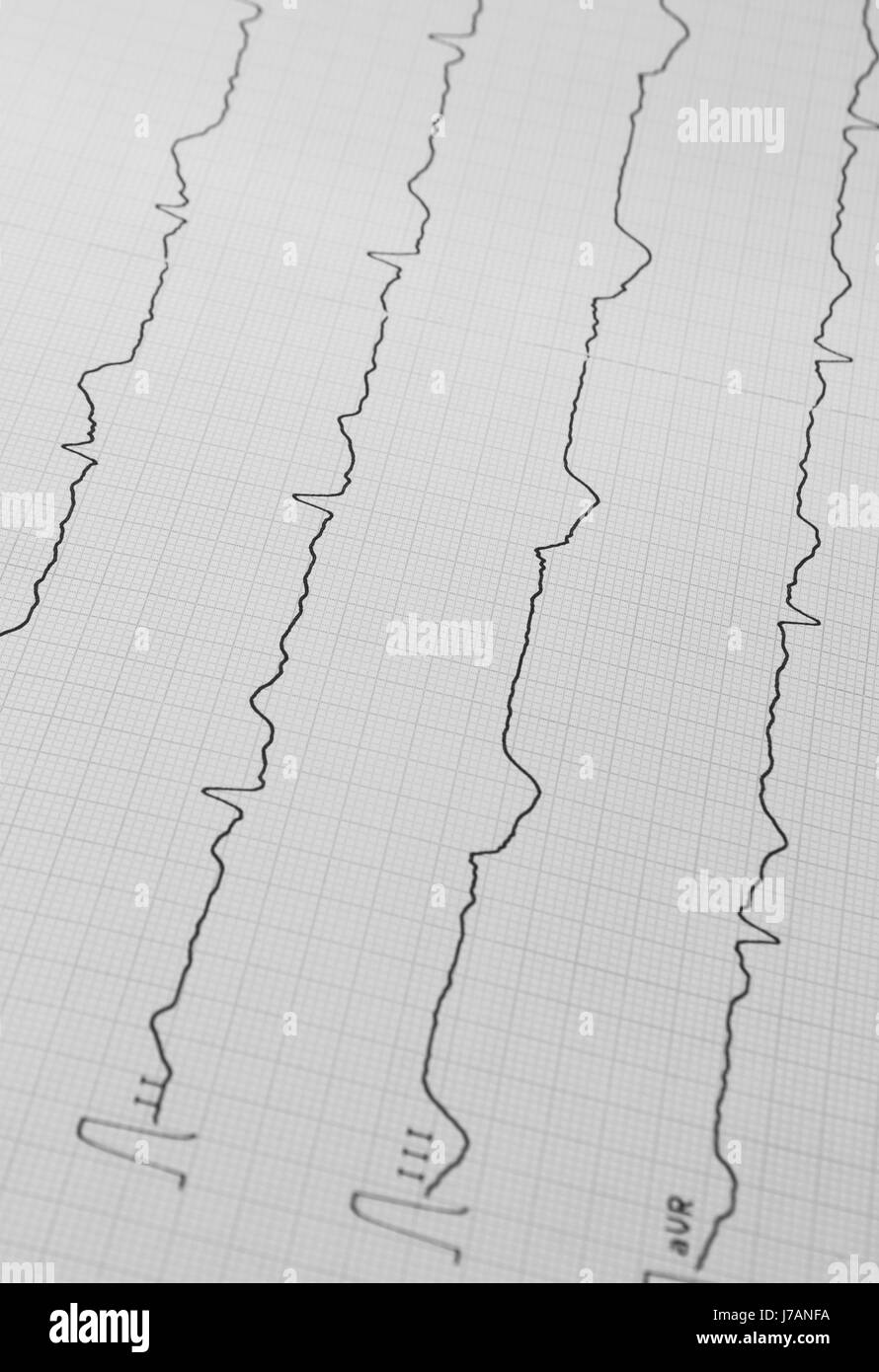 La salute di impulsi di heartbeat elettrocardiogramma medicina medicin malattia malattia Foto Stock