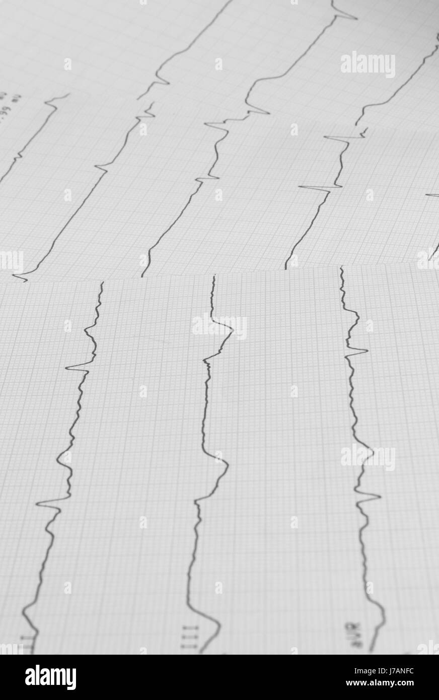 La salute di impulsi di heartbeat elettrocardiogramma medicina medicin malattia malattia Foto Stock