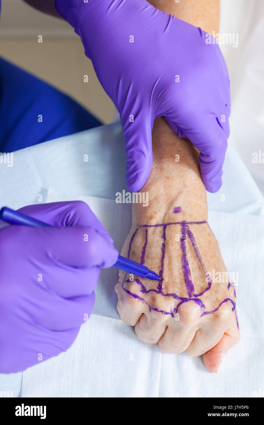 Un cosmetico chirurgo plastico medico utilizzando una penna marcatura fino alla mano di un senior donna femmina paziente in ospedale o in clinica prima di un intervento chirurgico Foto Stock