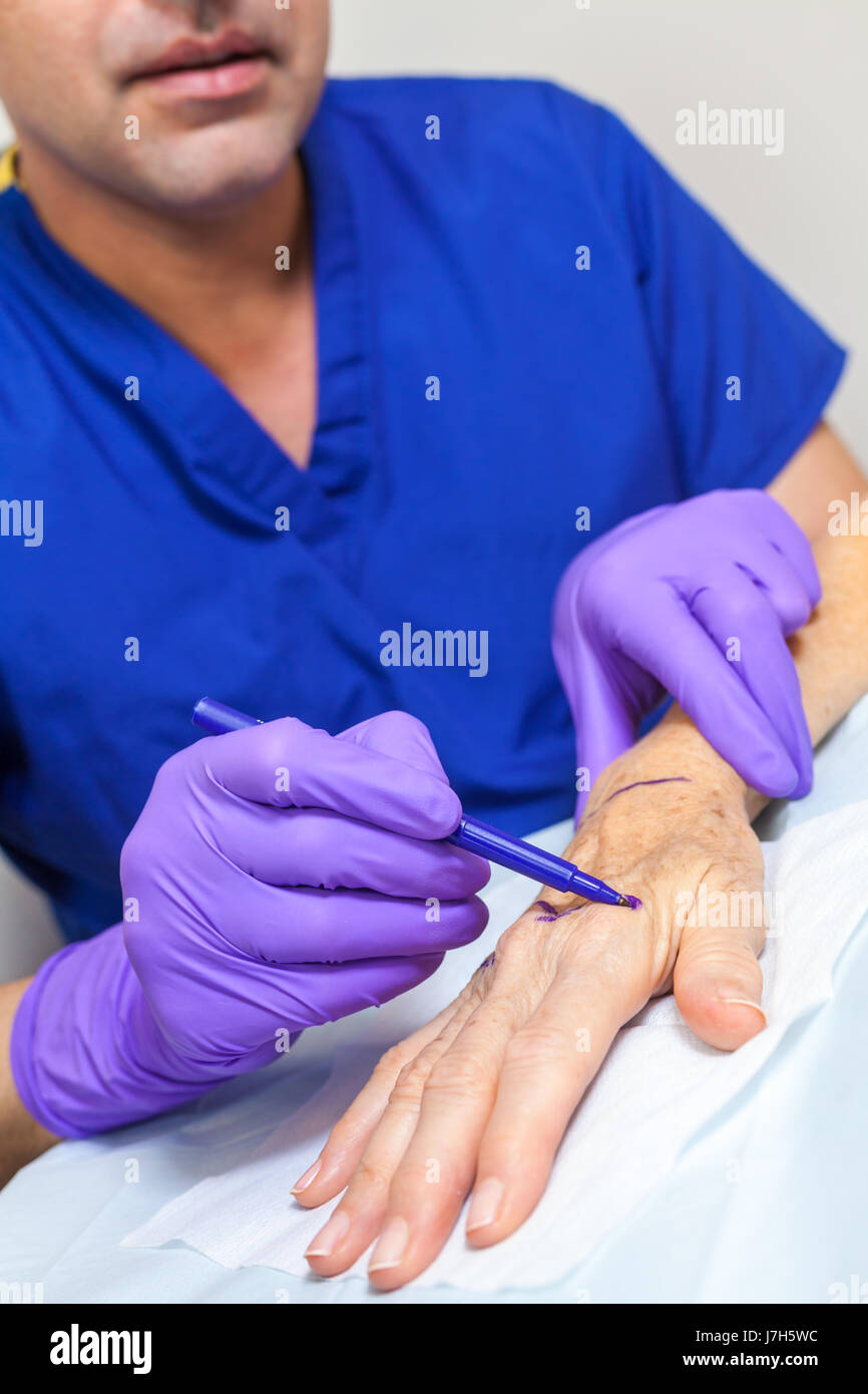 Un maschio di plastica cosmetico medico chirurgo utilizzando una penna marcatura fino alla mano di un senior donna femmina paziente in ospedale o in clinica prima di un intervento chirurgico Foto Stock