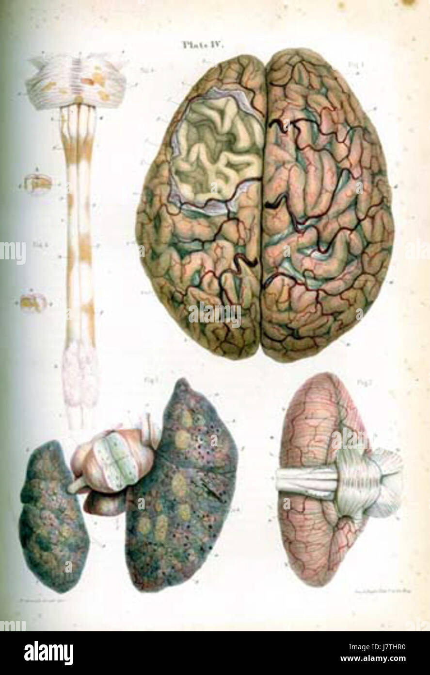 L'atrofia di Carswell è una condizione probabilmente correlata alla degenerazione muscolare o tissutale. È studiato per il suo impatto sulla salute umana, in particolare in relazione all'atrofia muscolare o alle malattie neurodegenerative. Foto Stock