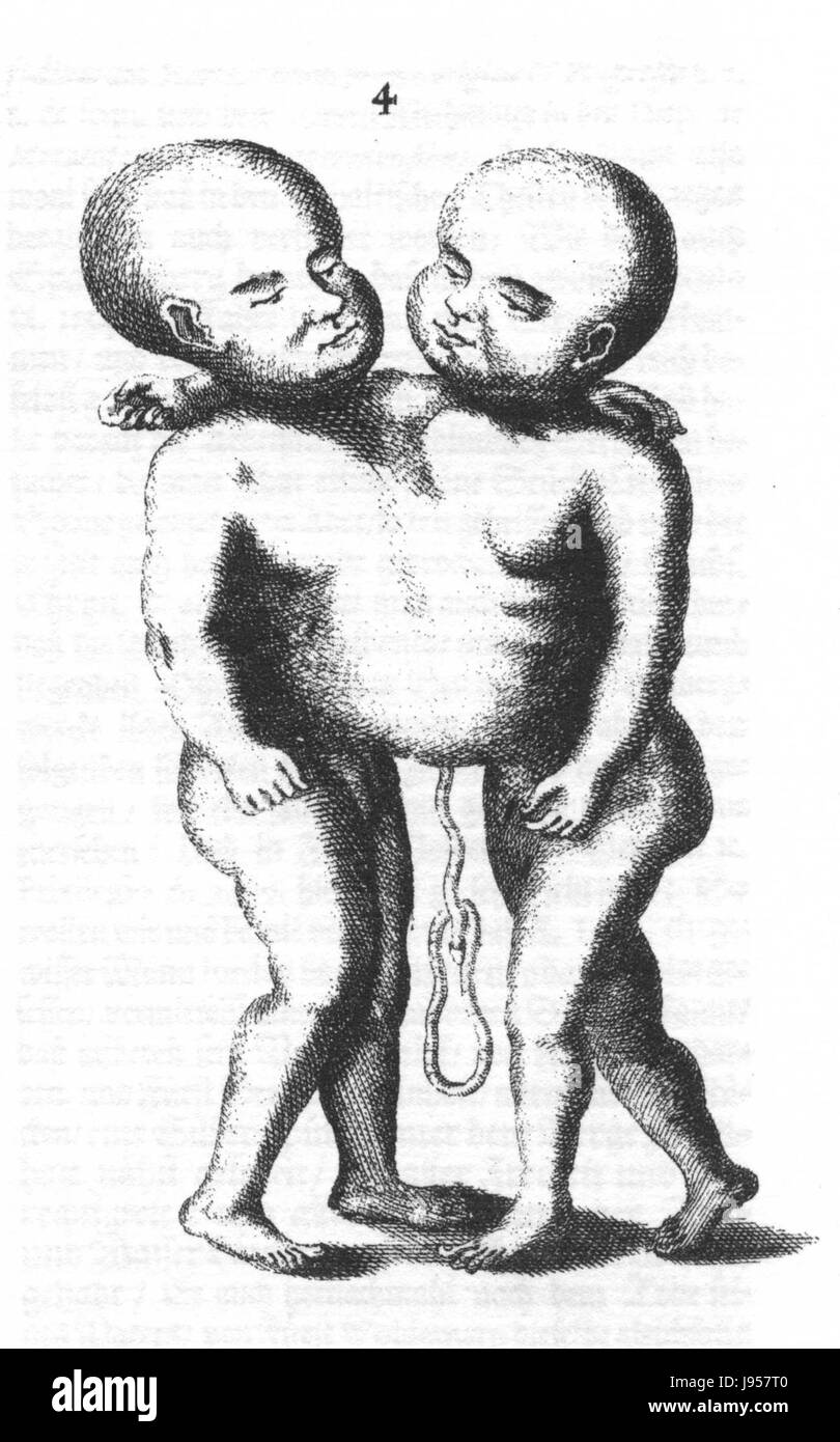Un'opera storica intitolata "Siamesische Zwillinge Dessau" del 1695, raffigurante il famoso caso di gemelli siamesi a Dessau. L'illustrazione, creata da Bekmann, documenta il raro fenomeno medico dei gemelli congiunti nella Germania del XVII secolo. Foto Stock