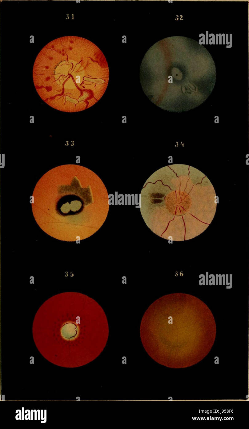 Questo piatto, tratto da un testo medico, illustra i cambiamenti naturali e patologici dell'occhio umano, fornendo un riferimento visivo per la comprensione della salute e delle malattie degli occhi. Foto Stock