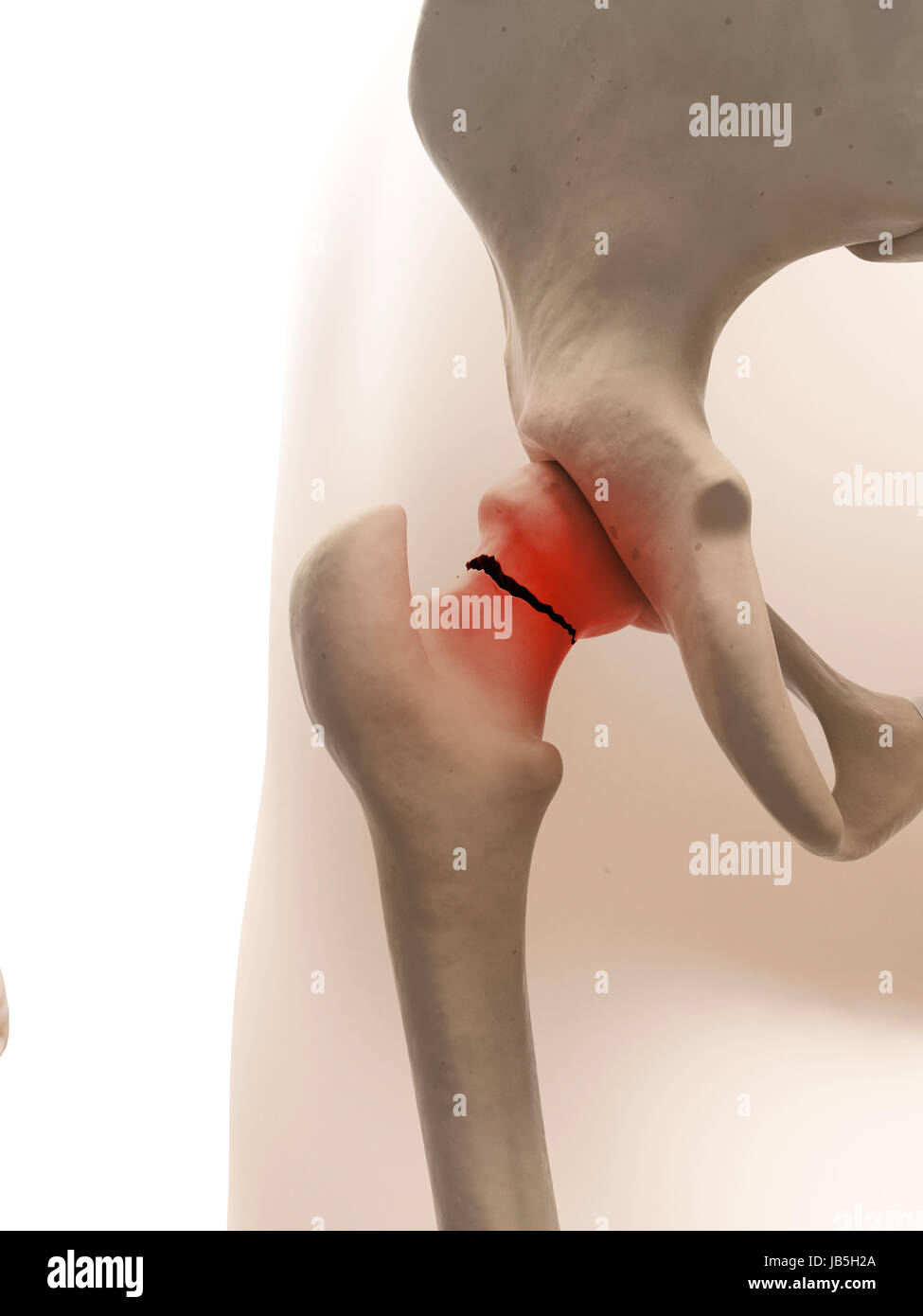 Illustrazione medica di anca rotto Foto Stock