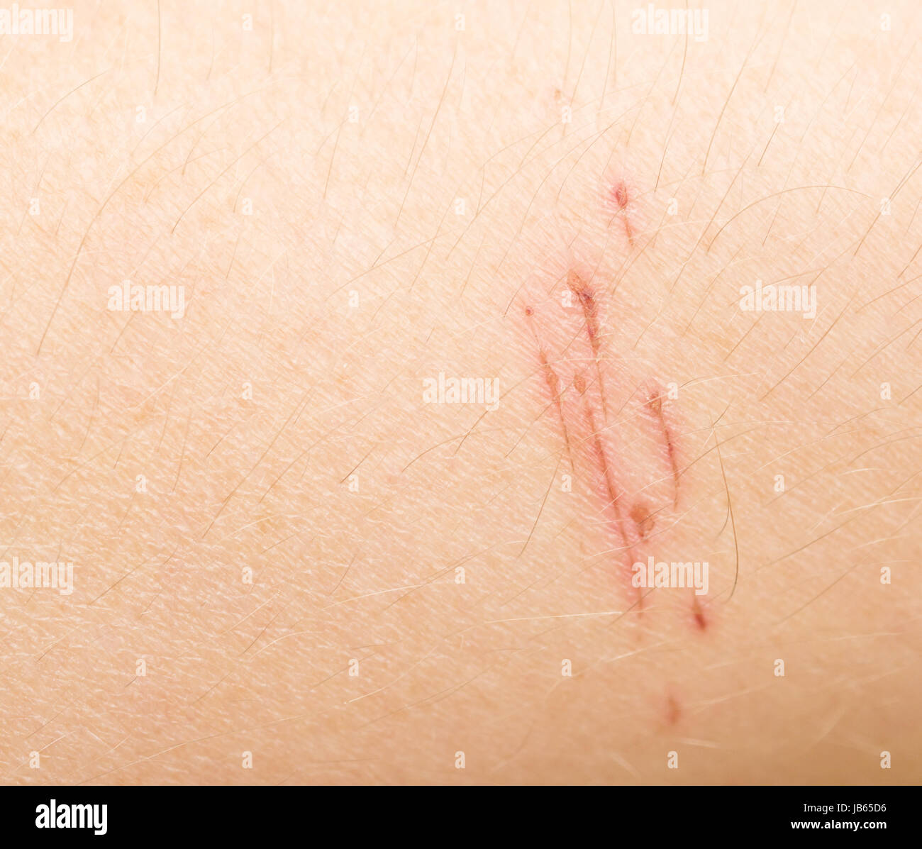 Graffi sulla pelle umana Foto stock - Alamy