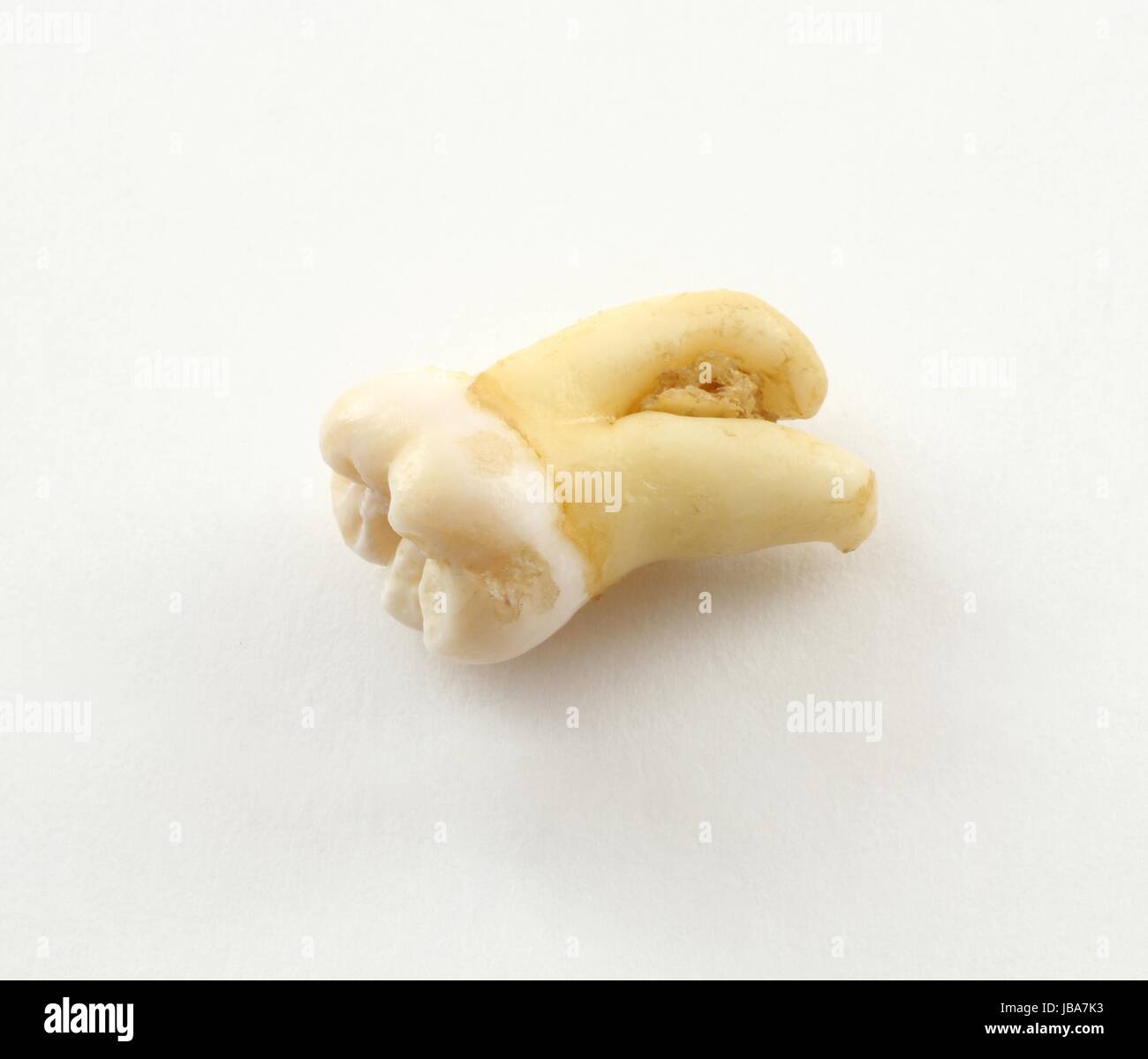 Rimuovere ottavo dente inferiore con un pezzo di tessuto osseo su carta. dente di saggezza Foto Stock