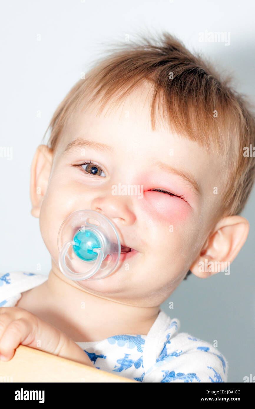 Little Boy - pericolose da punture di vespe vicino all'occhio Foto Stock