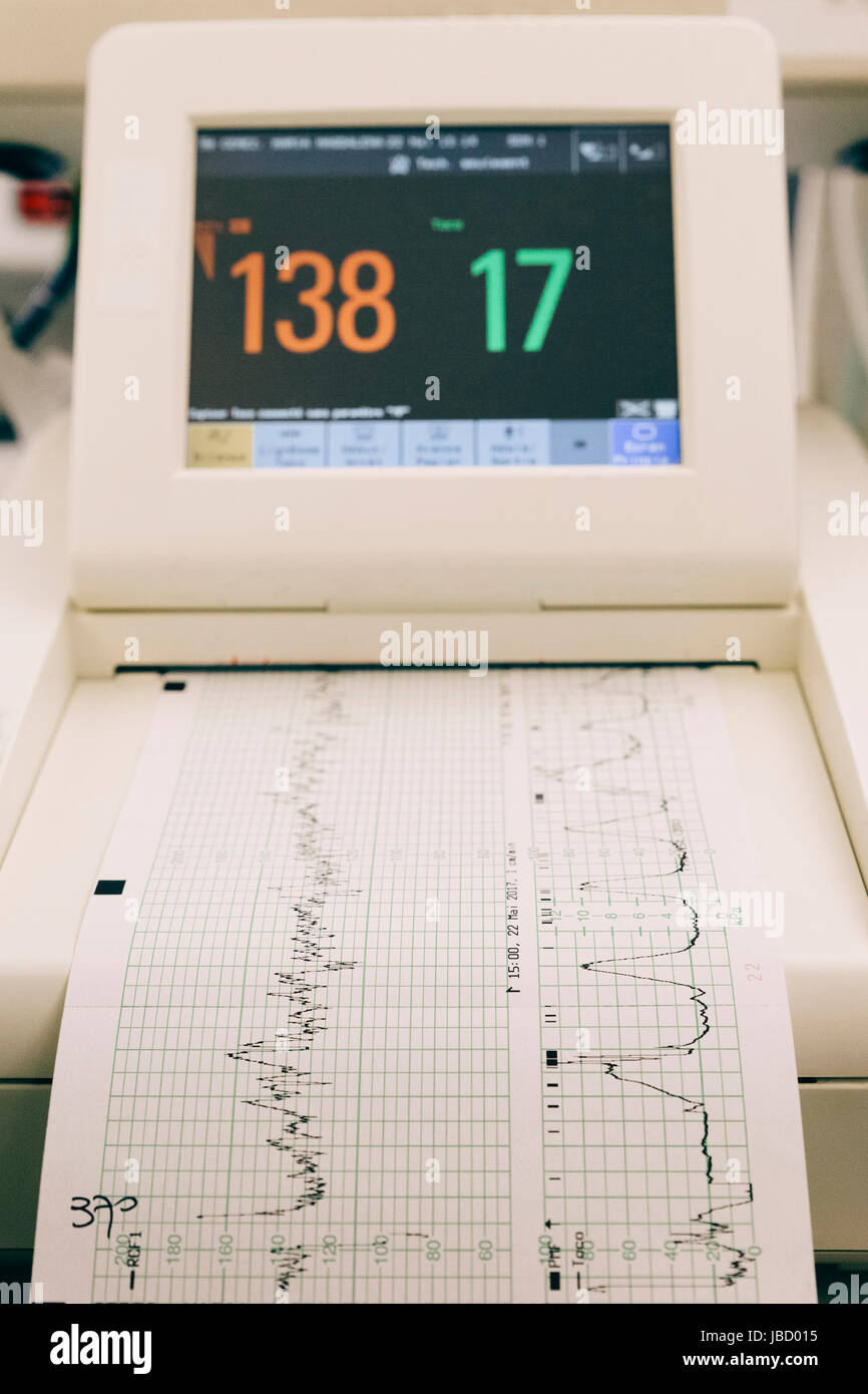 Monitoraggio del battito cardiaco fetale [Progetto Completo