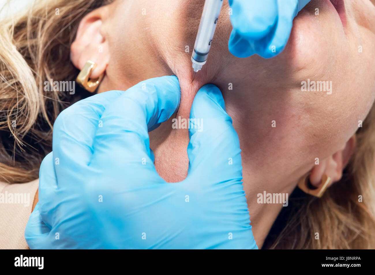 Il dermatologo cosmetico si applica un trattamento di bellezza con iniezione di tossina botulinica al mento ringiovanimento Foto Stock