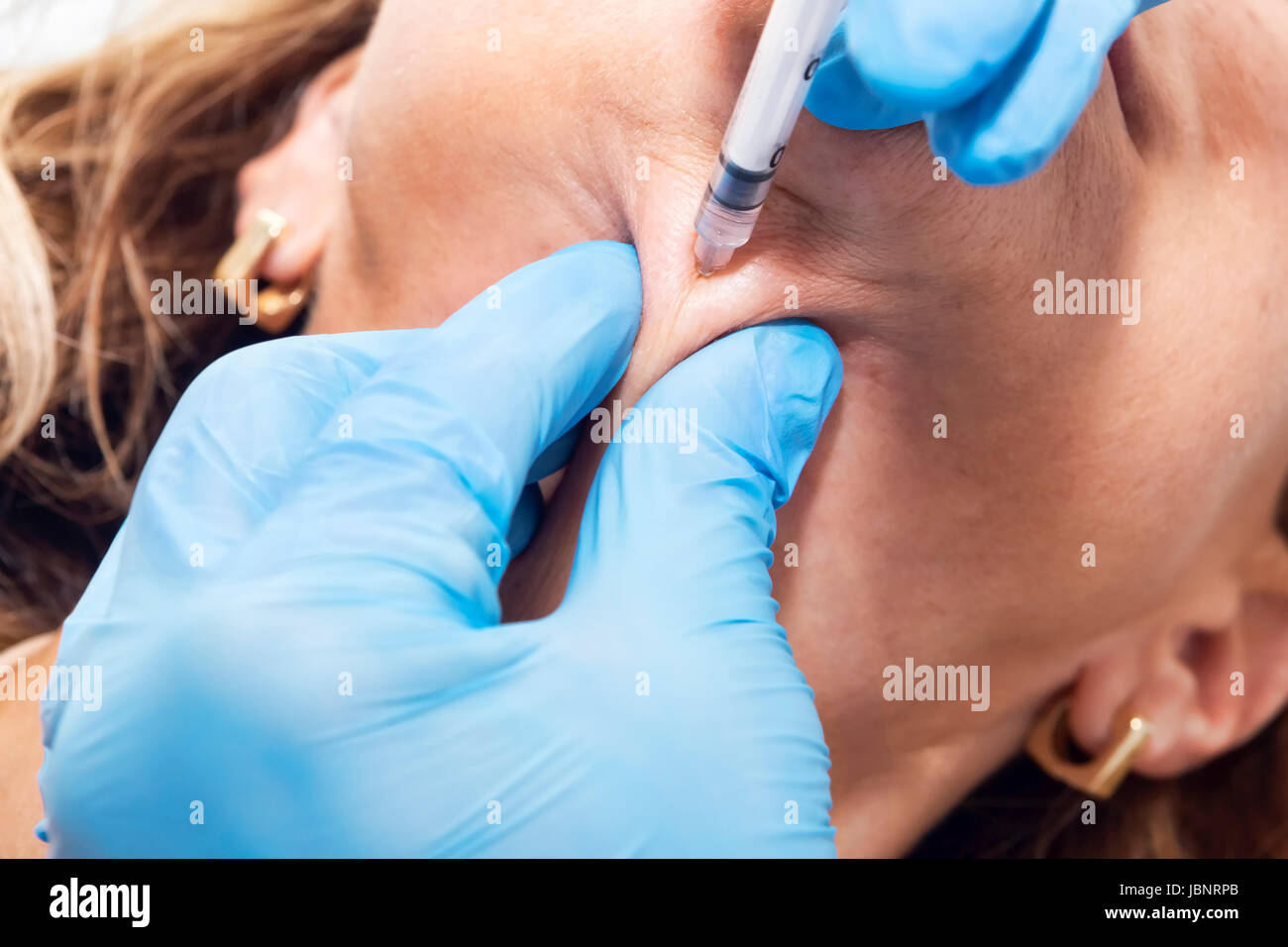 Il dermatologo cosmetico si applica un trattamento di bellezza con iniezione di tossina botulinica al mento ringiovanimento Foto Stock