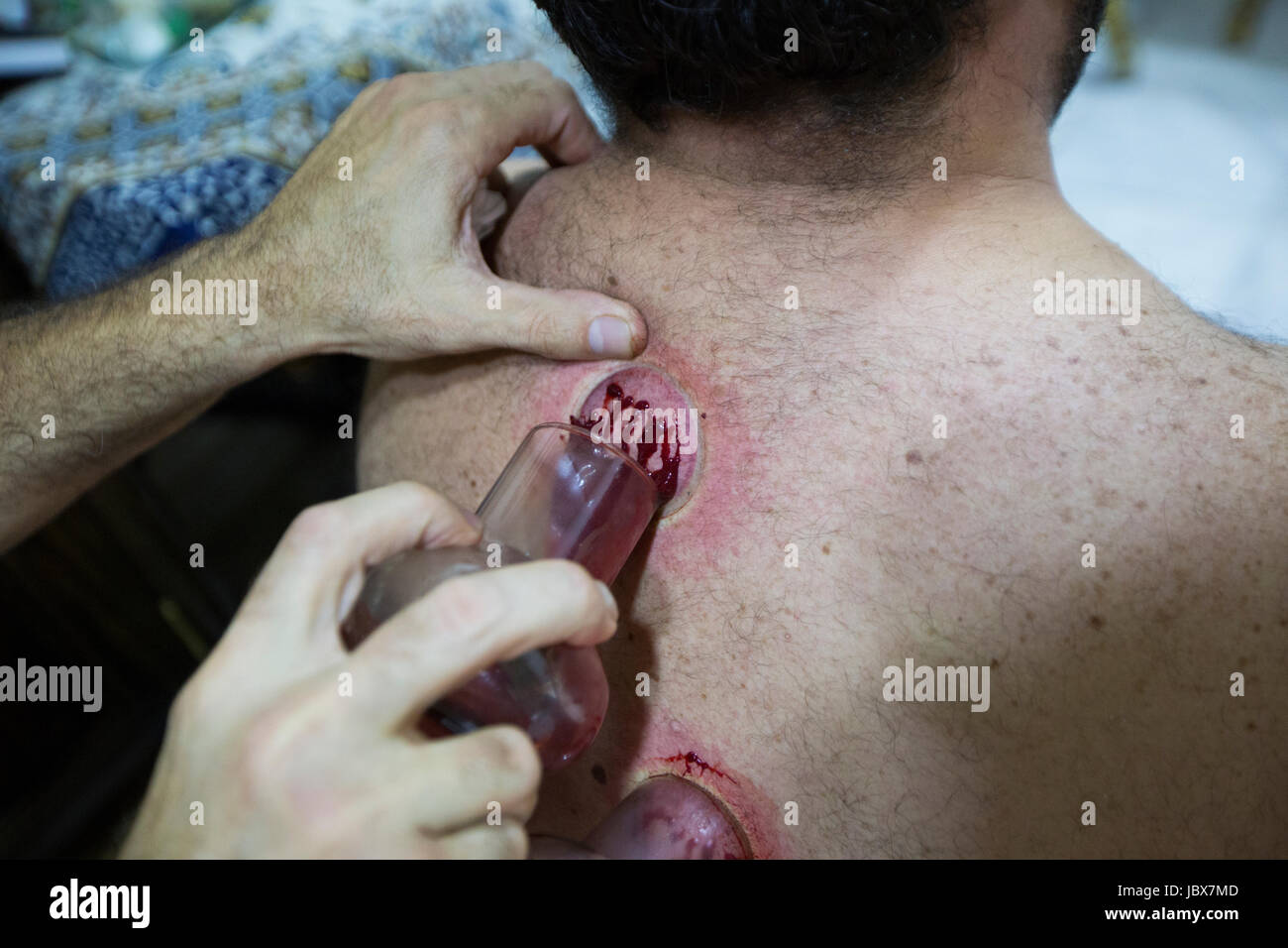 Dettagli di un uomo getting coppettazione effettuata con un terapeuta Foto Stock