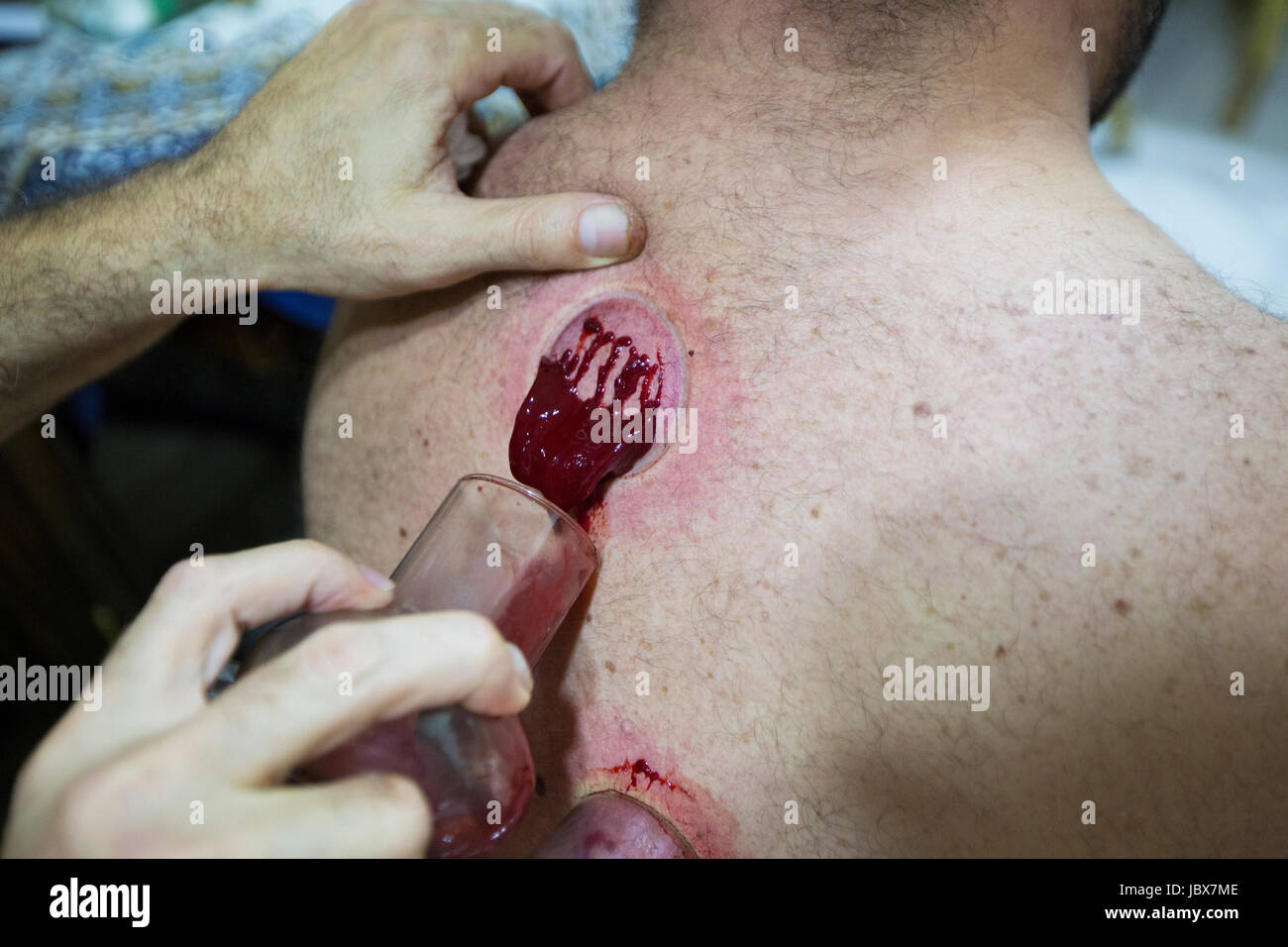 Dettagli di un uomo getting coppettazione effettuata con un terapeuta Foto Stock
