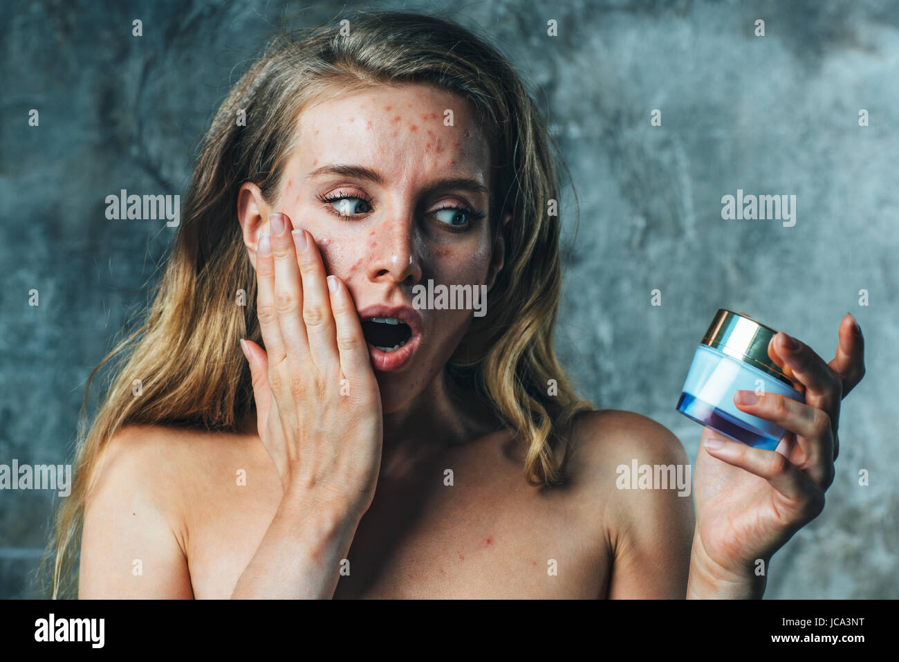 Giovane donna ha allergia sulla crema per il corpo. Il suo viso hanno un sacco di acne e lei è molto infelice. Foto Stock