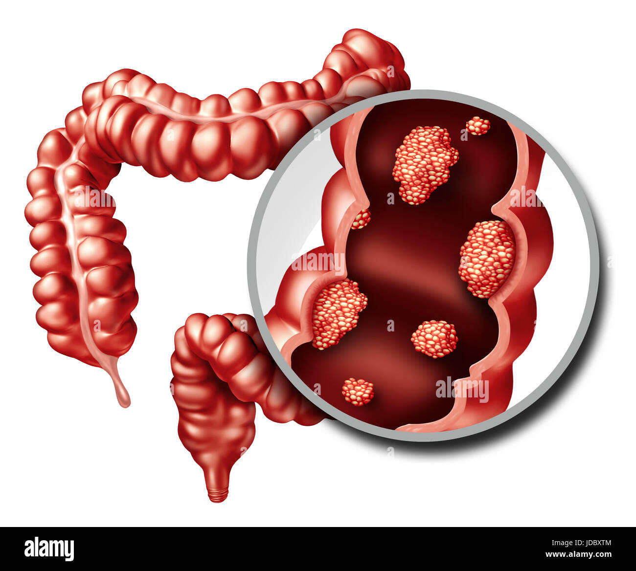 Il colon o il cancro del colon-retto concetto come un medico di illustrazione di un grosso intestino con un tumore maligno la crescita malattie del sistema digestivo. Foto Stock