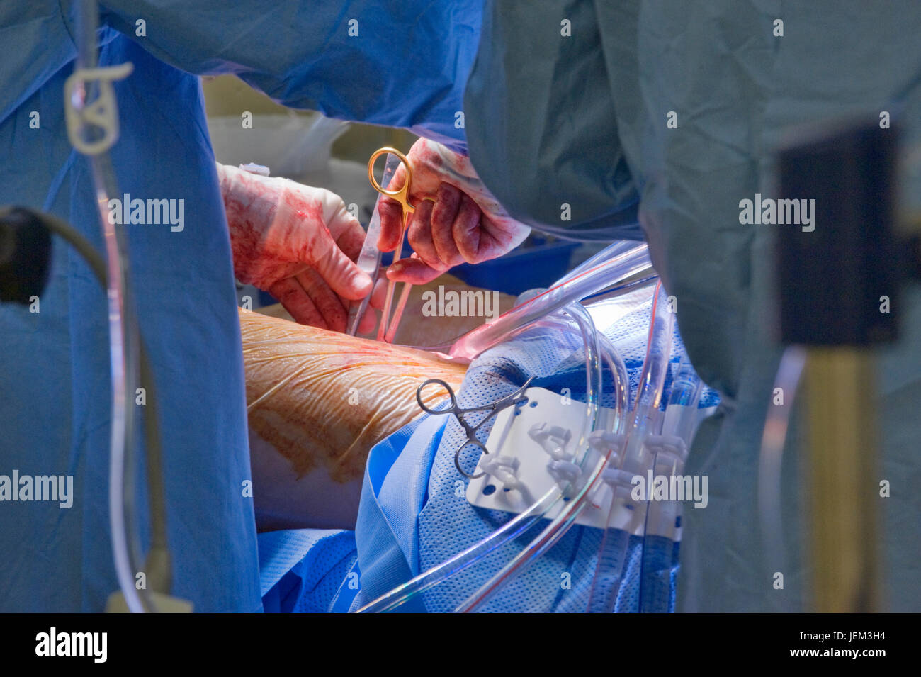 Le mani di un chirurgo che esegue la procedura cardiaca. Fotografato presso il Western General Hospital, Southampton, UK. Foto Stock