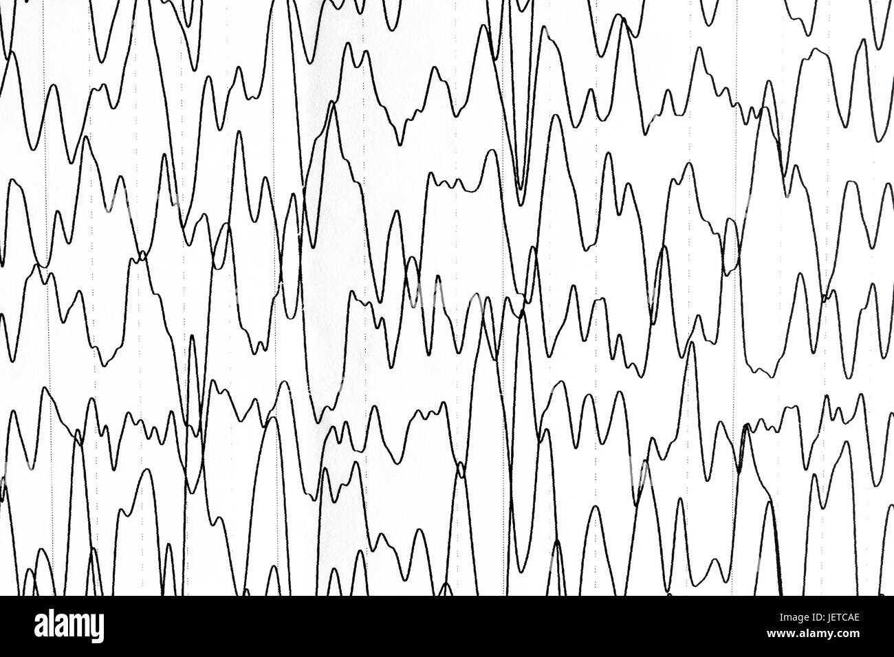 Elettroencefalografia test che mostra attività elettrica del cervello con disturbi neurologici caratterizzati da attacchi epilettici. Foto Stock