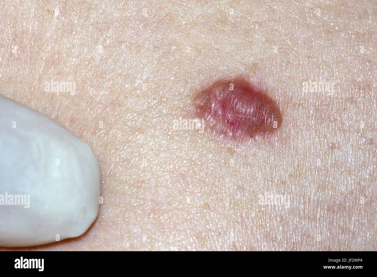 Il Carcinoma a cellule basali - di essere esaminato da un medico Foto Stock