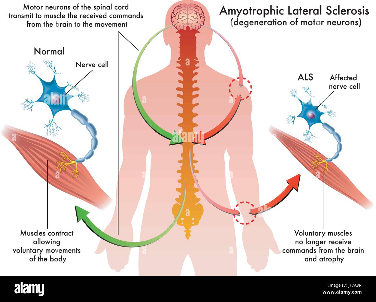 La paralisi cerebrale, ALS, sclerosi laterale amiotrofica, Lou gehrigs malattia, Illustrazione Vettoriale