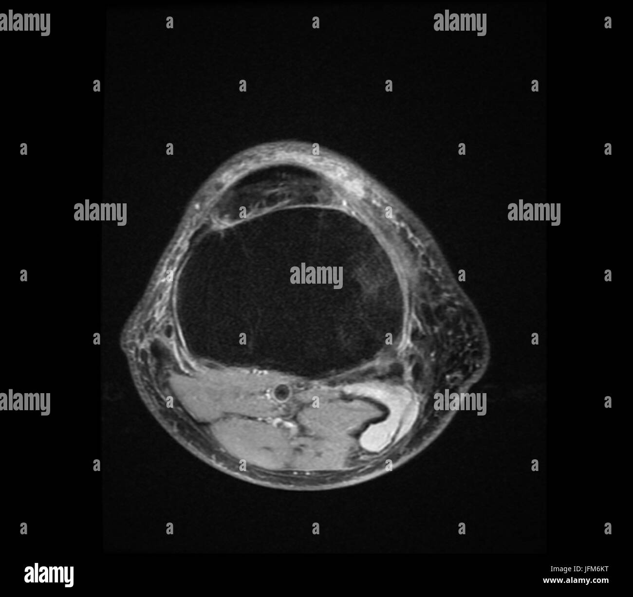 Negativa X ray immagine del ginocchio umano i reumatismi Foto Stock