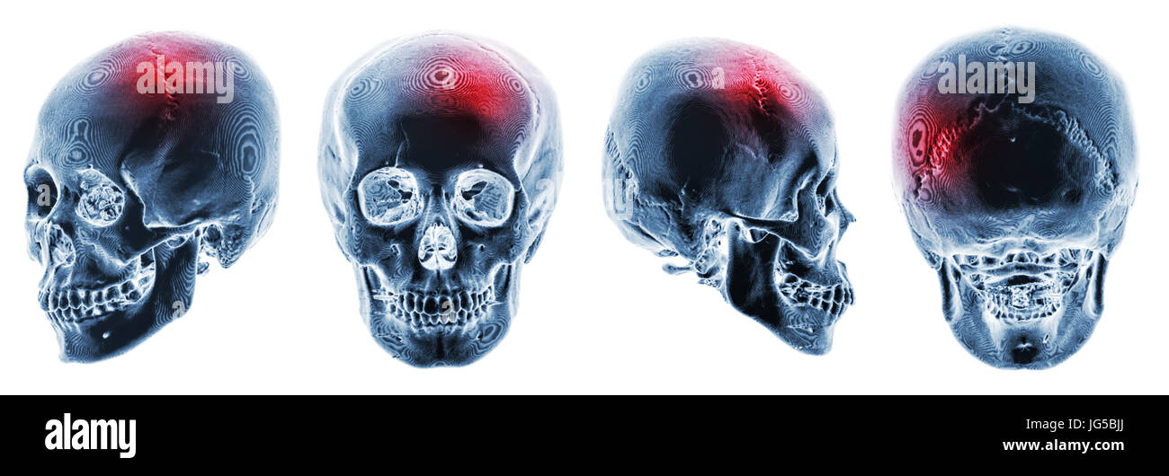 Cp . Accidente cerebrovascolare . 3D TAC DEL CRANIO umano . Modalità di visualizzazione multipla . Invertire il colore stile . Foto Stock