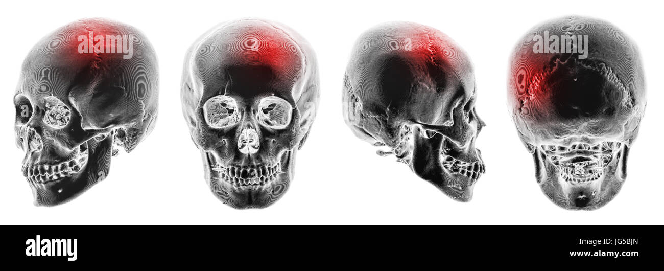 Cp . Accidente cerebrovascolare . 3D TAC DEL CRANIO umano . Modalità di visualizzazione multipla . Invertire il colore stile . Foto Stock
