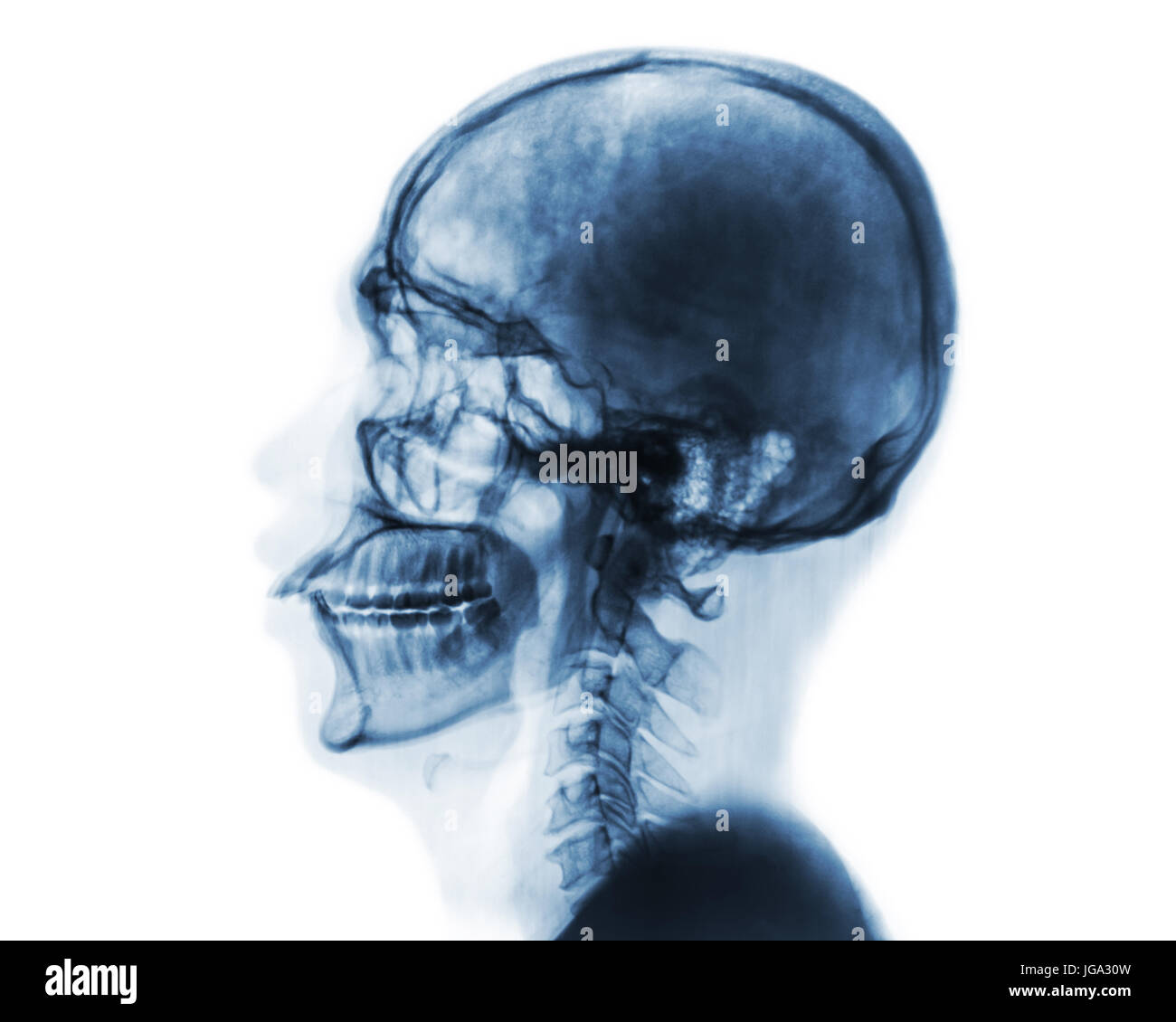 X-ray normale del cranio e della colonna vertebrale cervicale . Vista laterale . Invertire il colore stile . Foto Stock