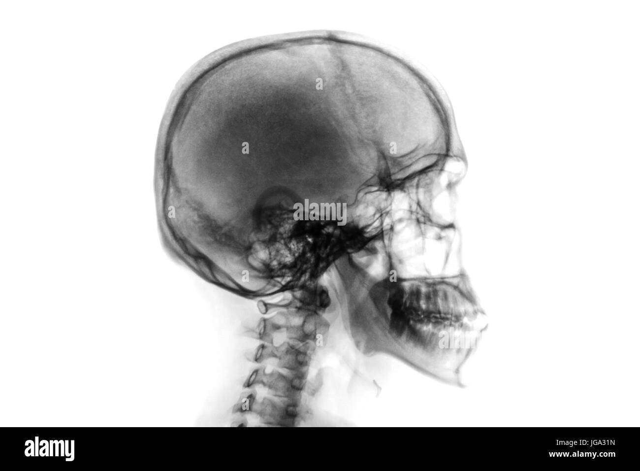 X-ray normale del cranio e della colonna vertebrale cervicale . Vista laterale . Invertire il colore stile . Foto Stock