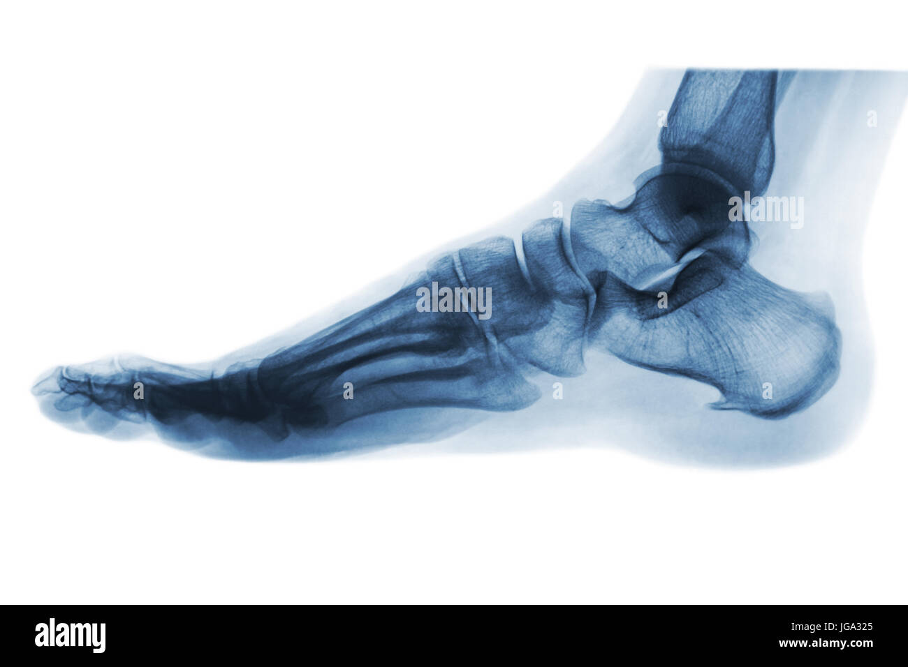 X-ray normale piede umano . Vista laterale . Invertire il colore stile . Foto Stock