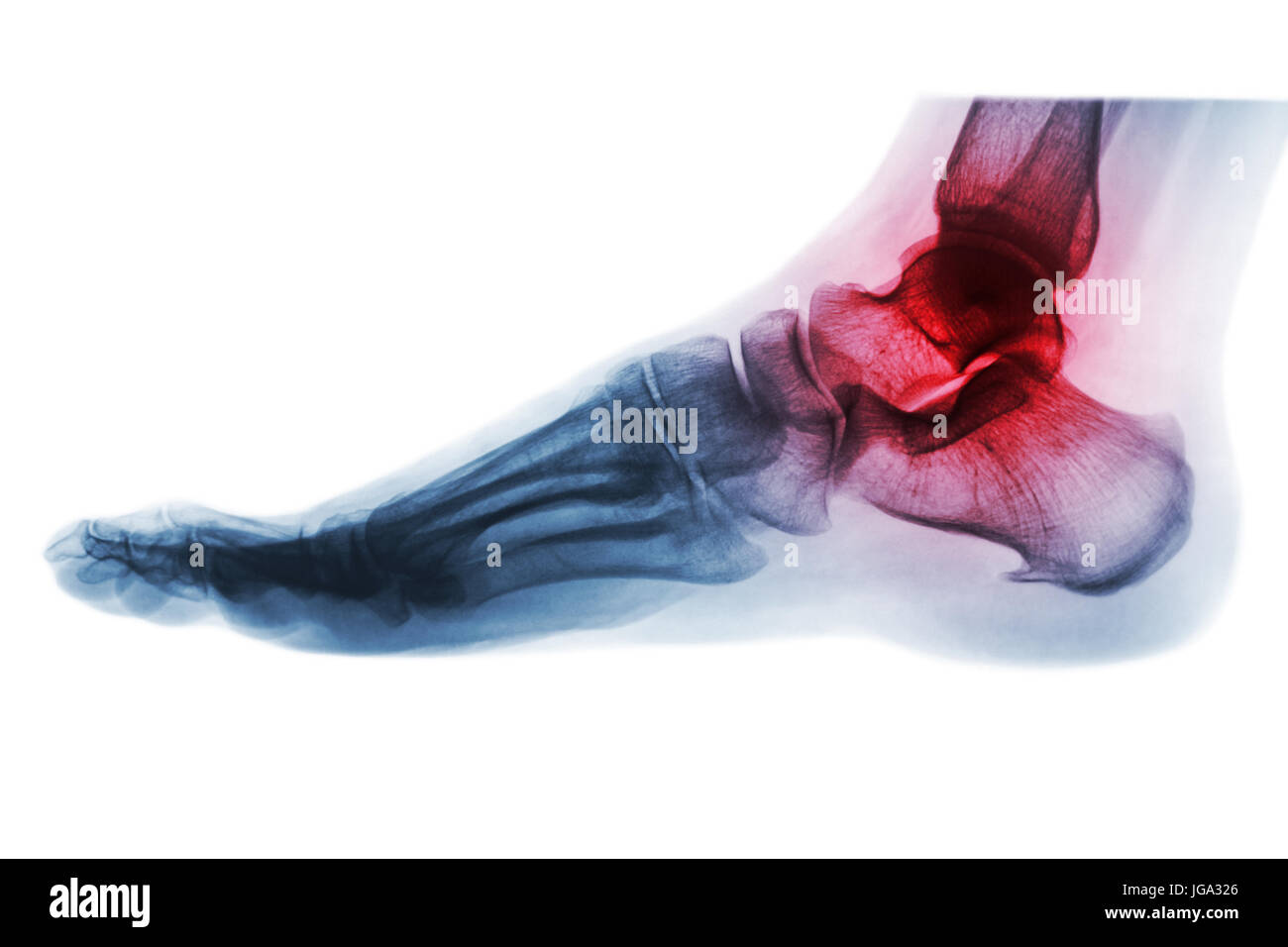 Artrite di caviglia . X-ray dei piedi . Vista laterale . Invertire il colore stile . Foto Stock