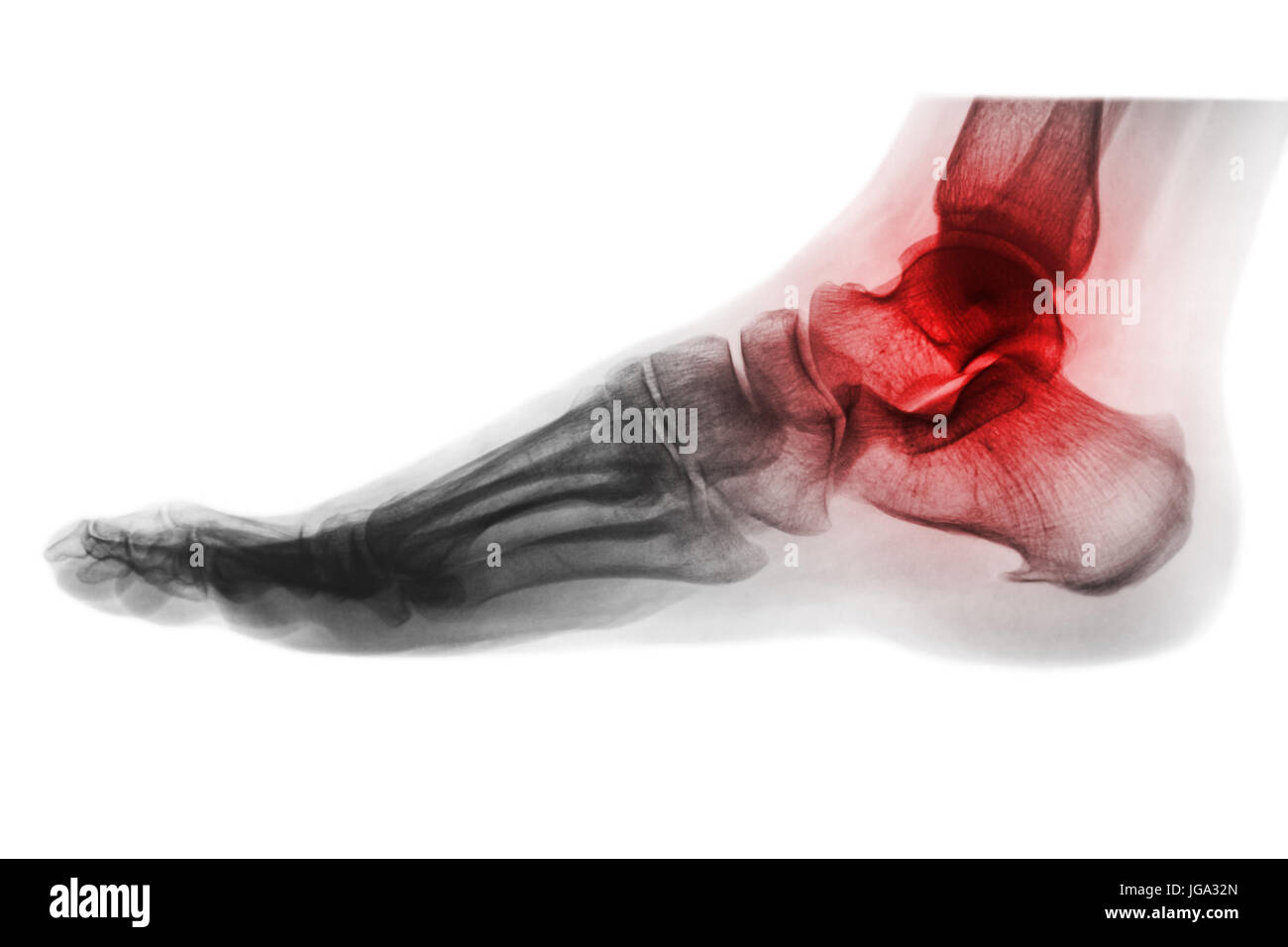 Artrite di caviglia . X-ray dei piedi . Vista laterale . Invertire il colore stile . Foto Stock