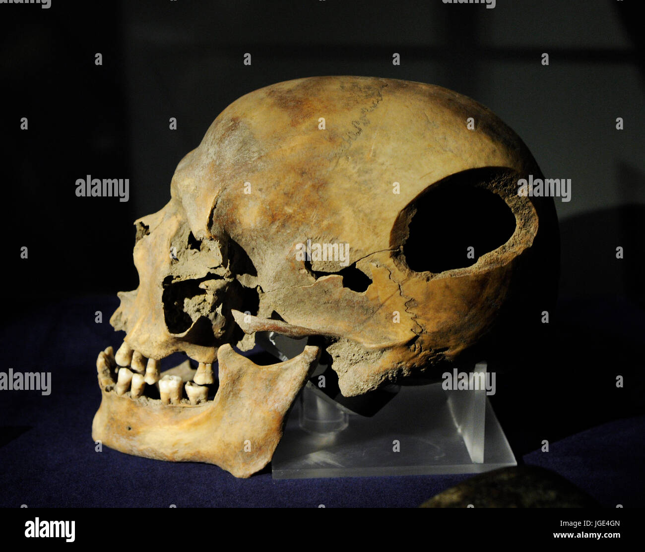 Il cranio con il marchio o una ferita mortale. Svedese museo storico. Stoccolma. La Svezia. Foto Stock