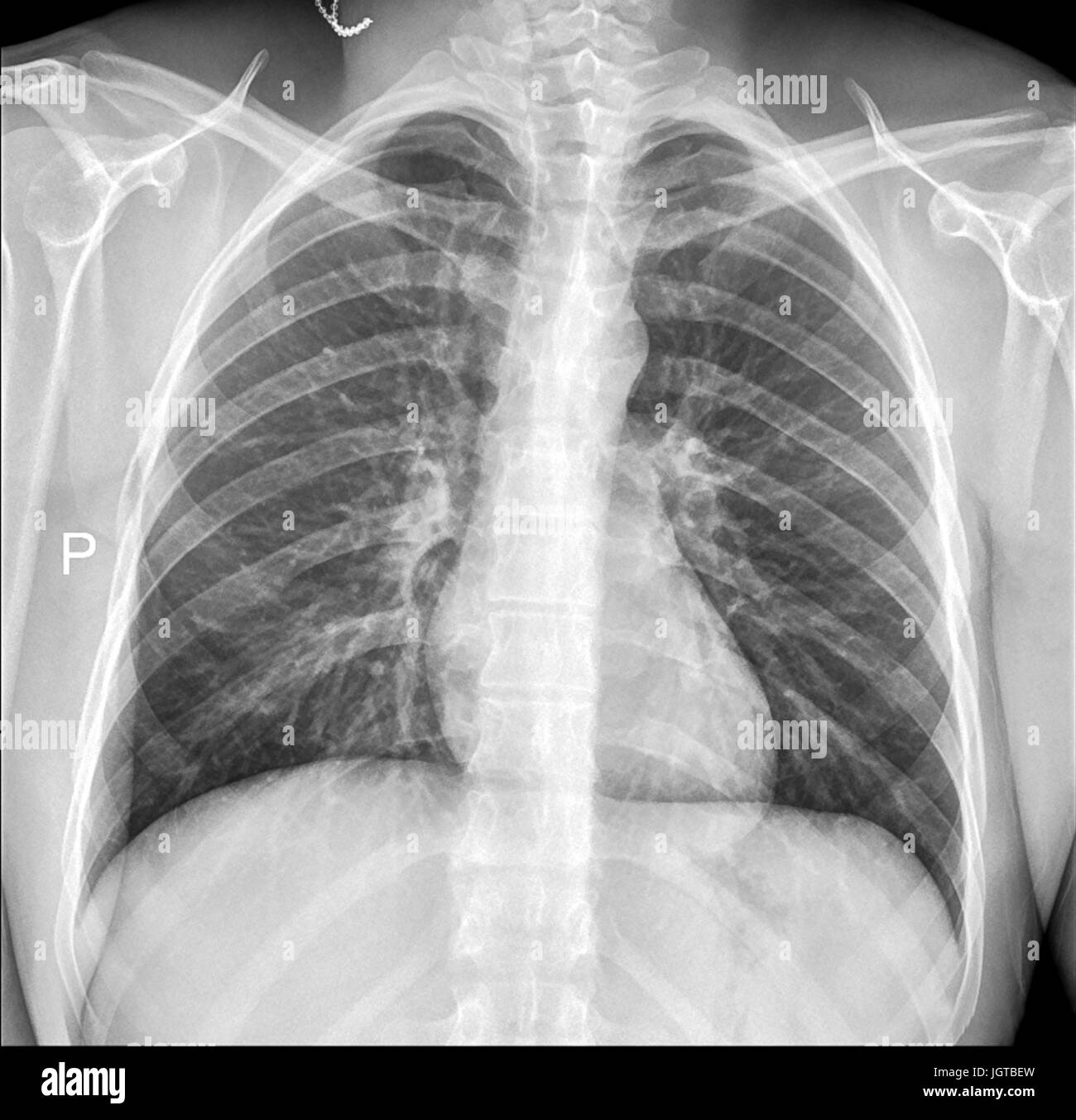 Petto Medical Xray, polmoni e cuore vista, il trattamento del paziente Foto Stock