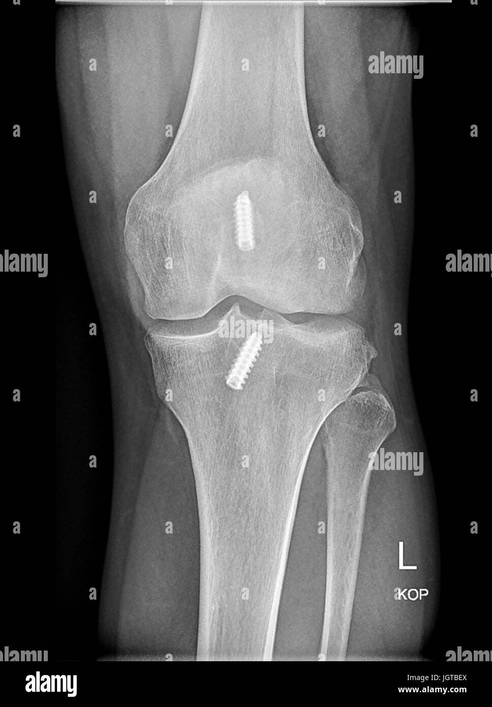 Interferenza femorale vite, anatomica per la ricostruzione del legamento crociato anteriore del ginocchio, medico xray Foto Stock