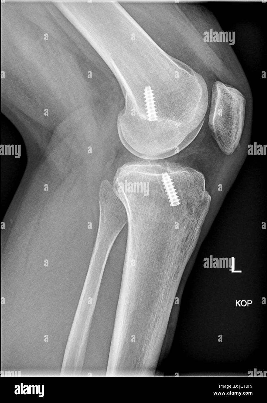 Interferenza femorale vite, anatomica per la ricostruzione del legamento crociato anteriore del ginocchio, medico xray Foto Stock