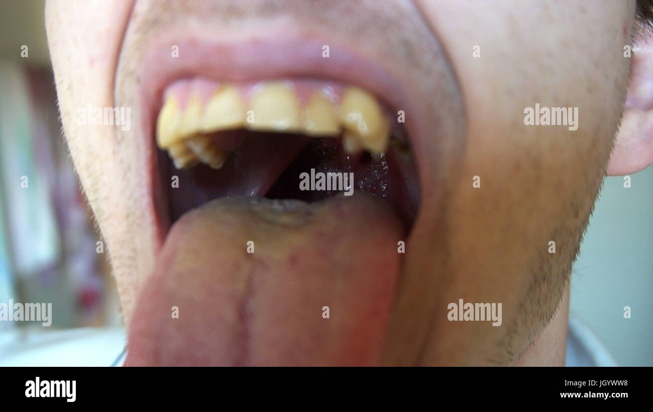 L'uomo apre la bocca e mostra la gola con la lingua e le tonsille. La  cavità della bocca e dei denti fumatore con la carie dentale e pietre Foto  stock - Alamy