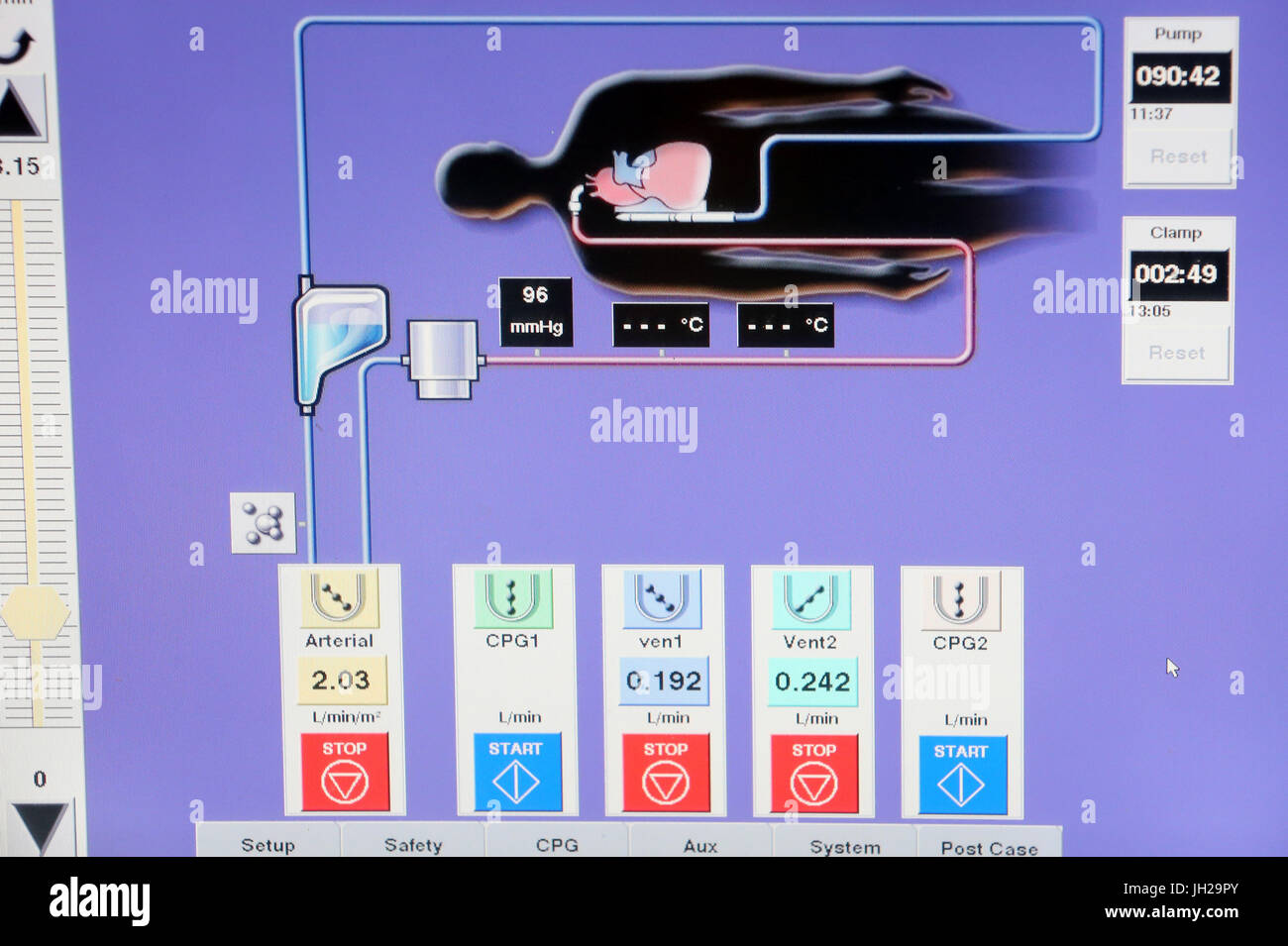 Teatro operativo. Il monitoraggio. Per Cardioplegia. Ho Chi Minh City. Il Vietnam. Foto Stock