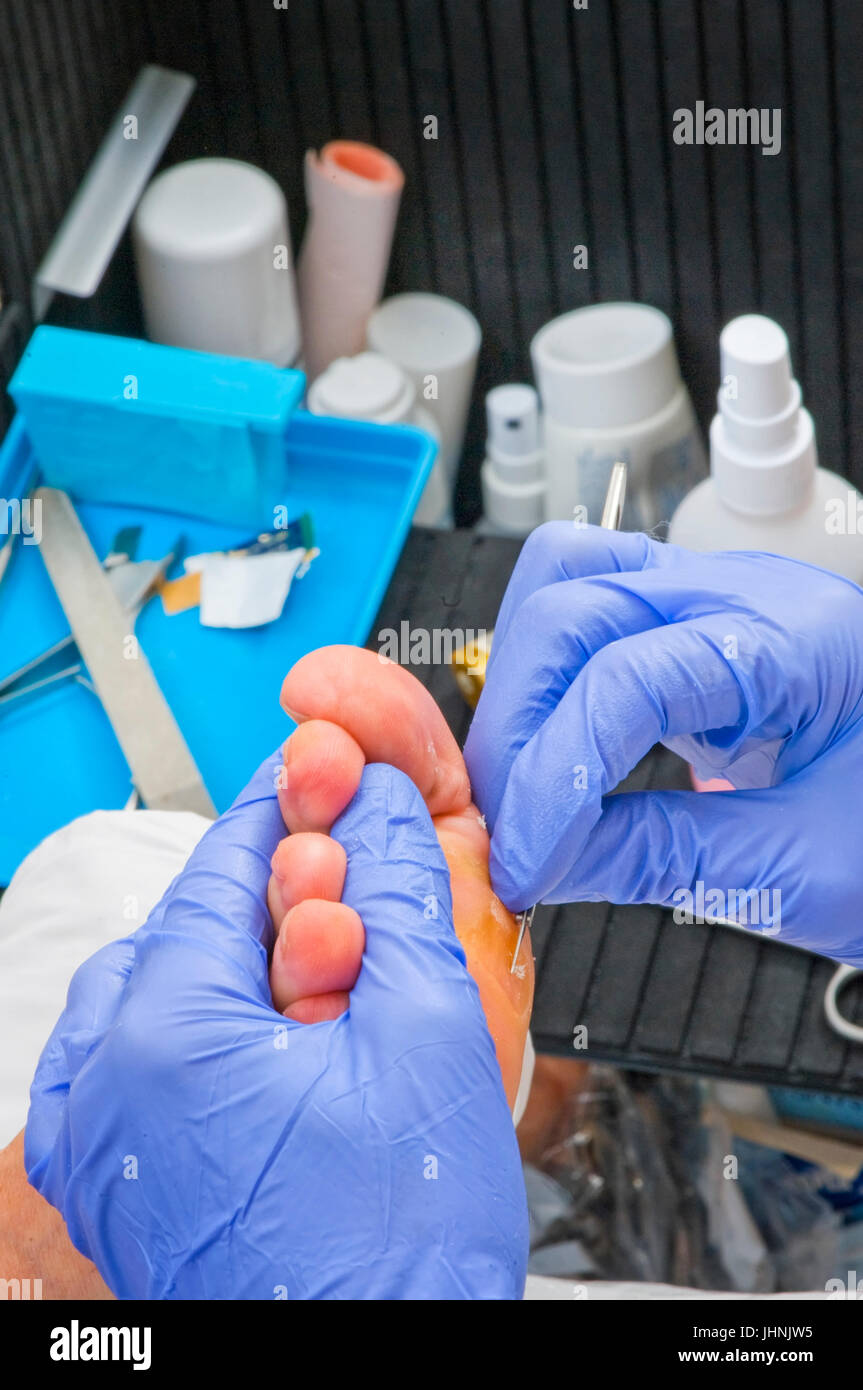 Pedicure utilizza un bisturi per rimuovere la pelle indurita di un grano sulla sfera di piede di una donna. Foto Stock