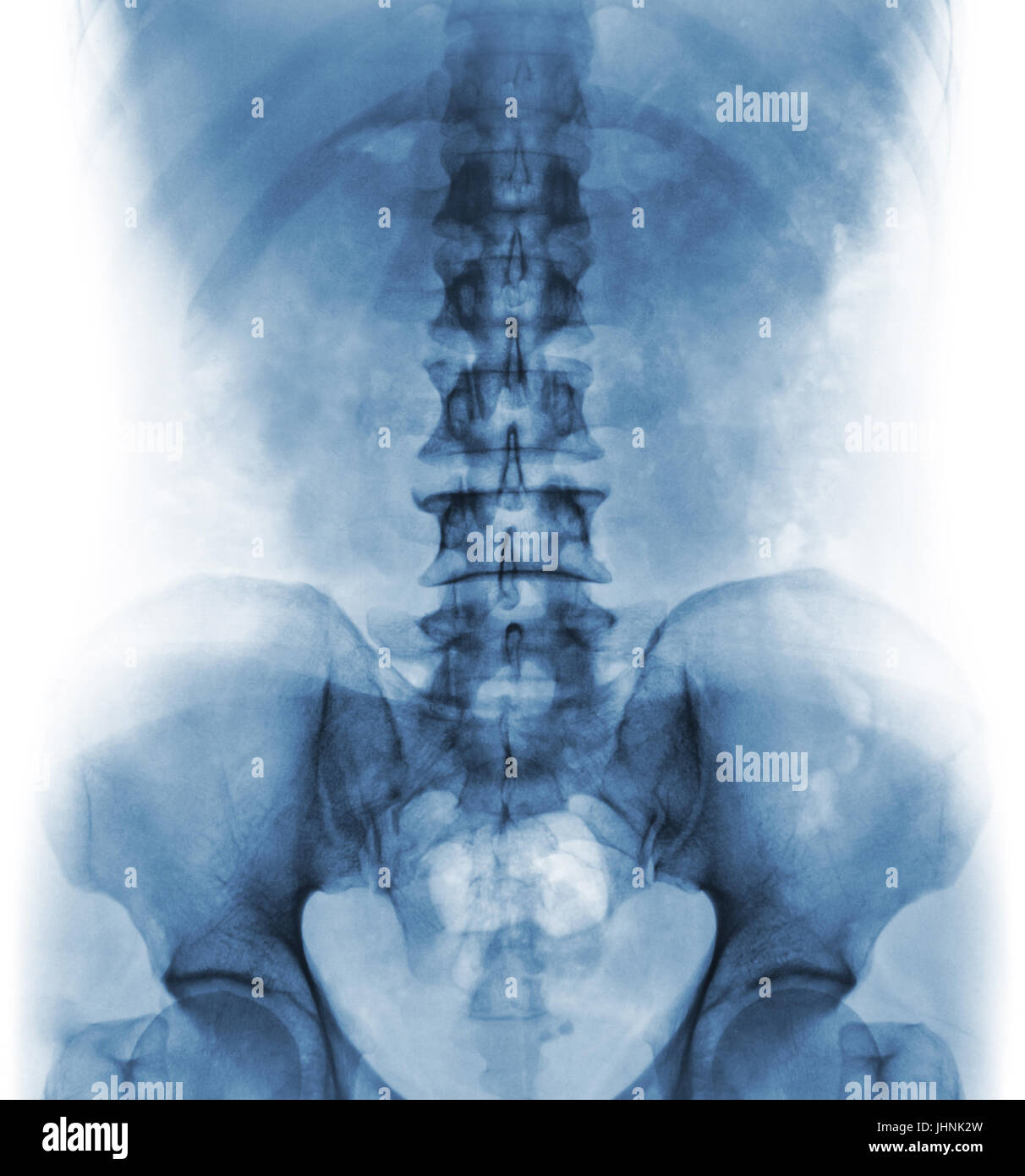 Film x-ray di umano normale della colonna vertebrale lombare . Vista frontale . Foto Stock
