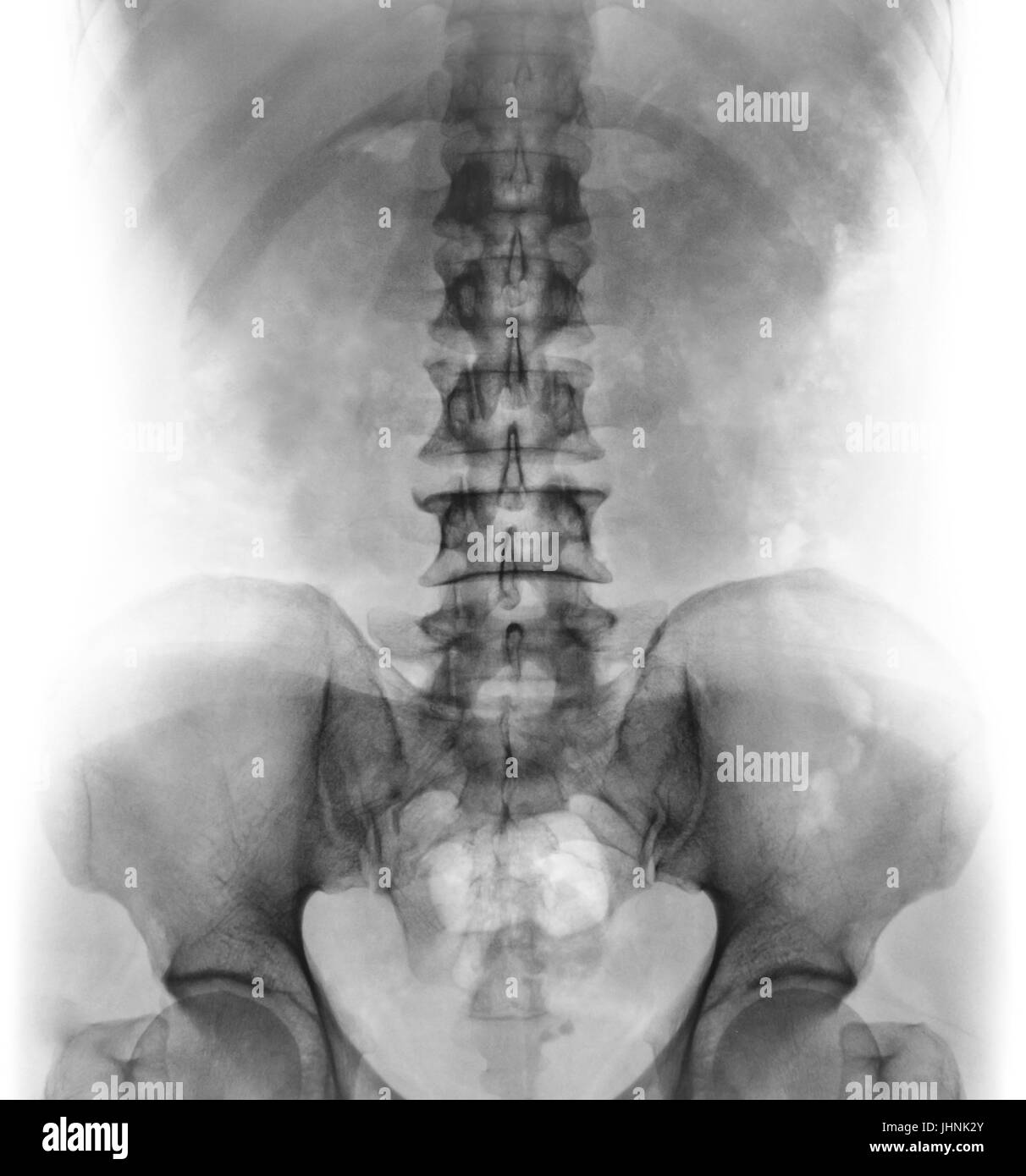 Film x-ray di umano normale della colonna vertebrale lombare . Vista frontale . Foto Stock