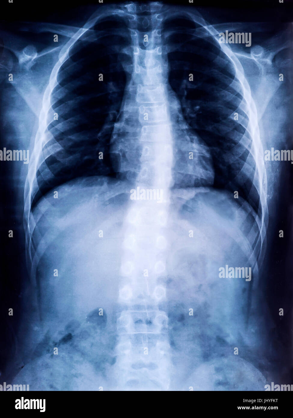 Pellicola a raggi X della colonna vertebrale umana la scoliosi per diagnosi mediche Foto Stock